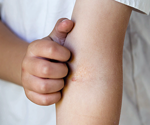 du_neurodermitis_silo_juckender_hautausschlag