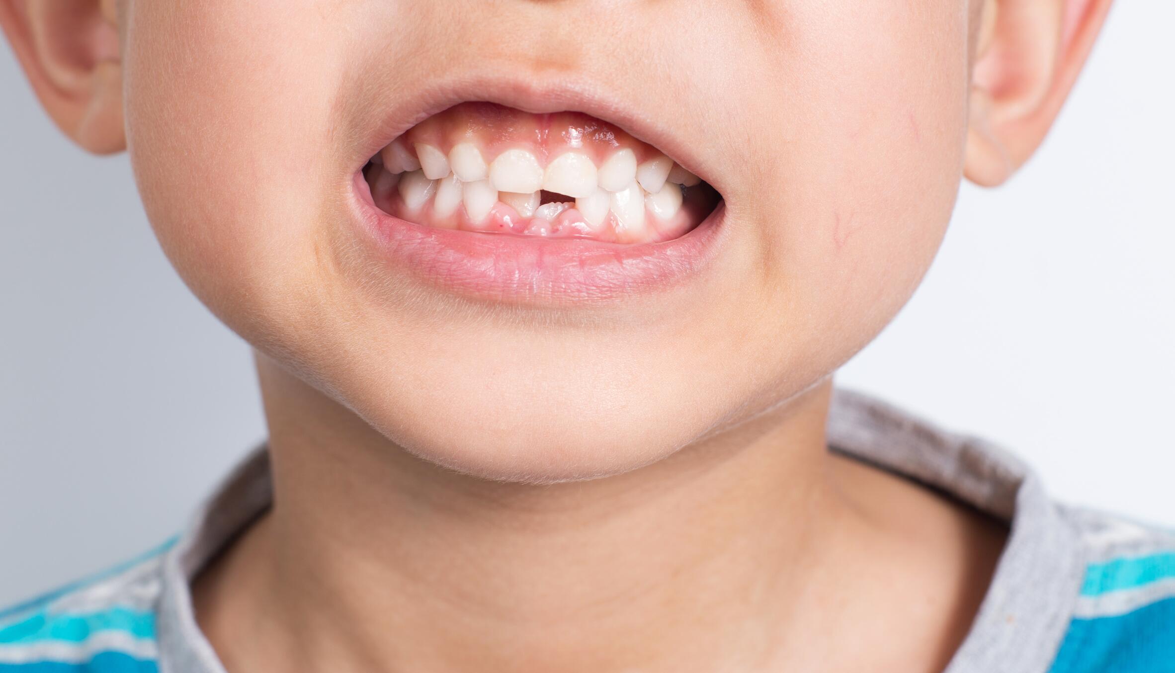 Connaître les symptômes d'une poussée dentaire de bébé - Dentiste