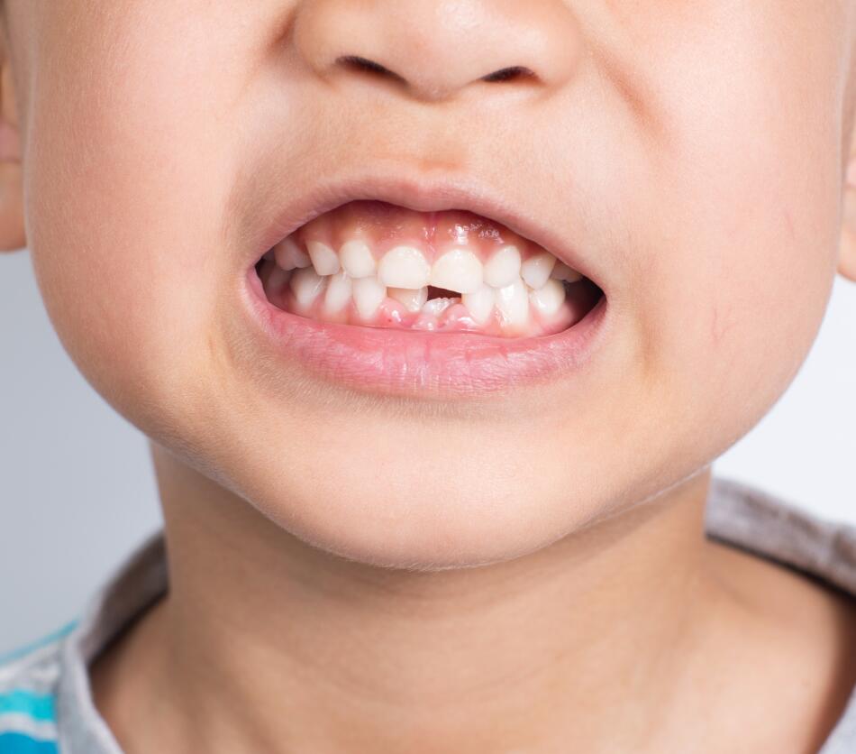 Une routine complète, douce et efficace adaptée aux dents définitives des enfants.