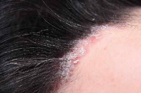 du_neurodermitis_silo_psoriasis_schuppenflechte_kopf