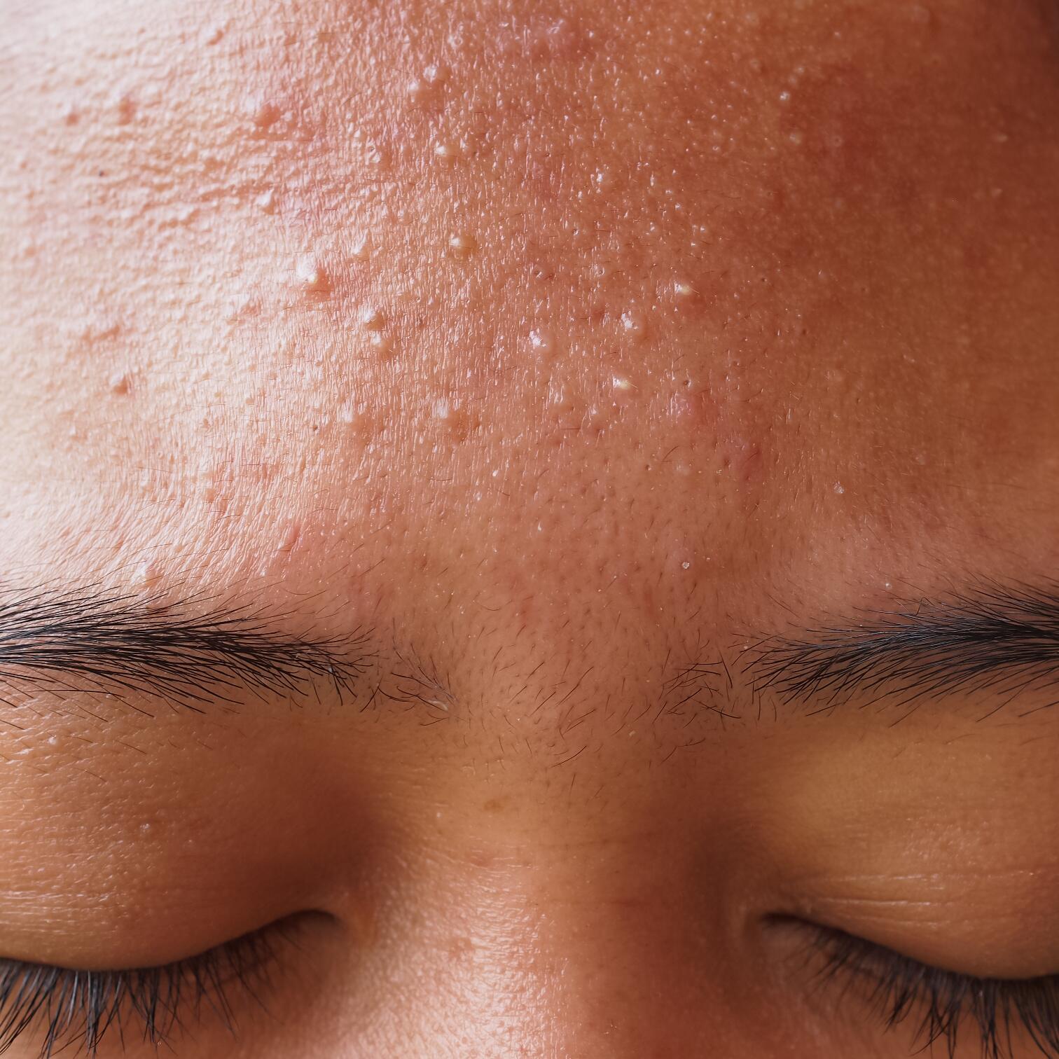AD_ACNE_NOSE-MICROKYSTE-PIMPLE_SQUARE_2021 472x472