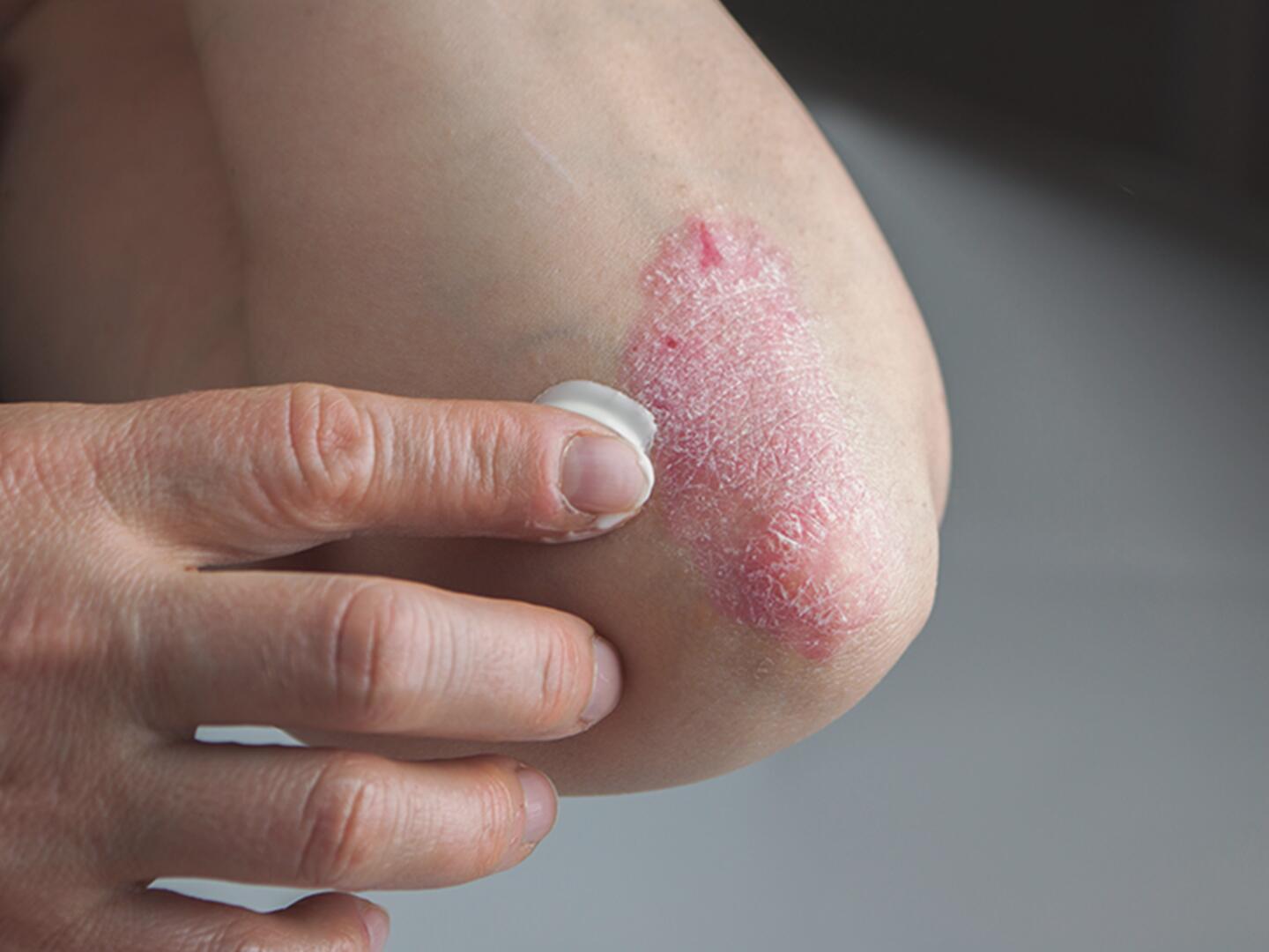 DU_3_Schuppenflechte_Behandlung_DU_Schuppenflechte_Behandlung_textmodul2-png