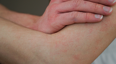 du_neurodermitis_silo_456x250_juckende_haut_ursachen_3