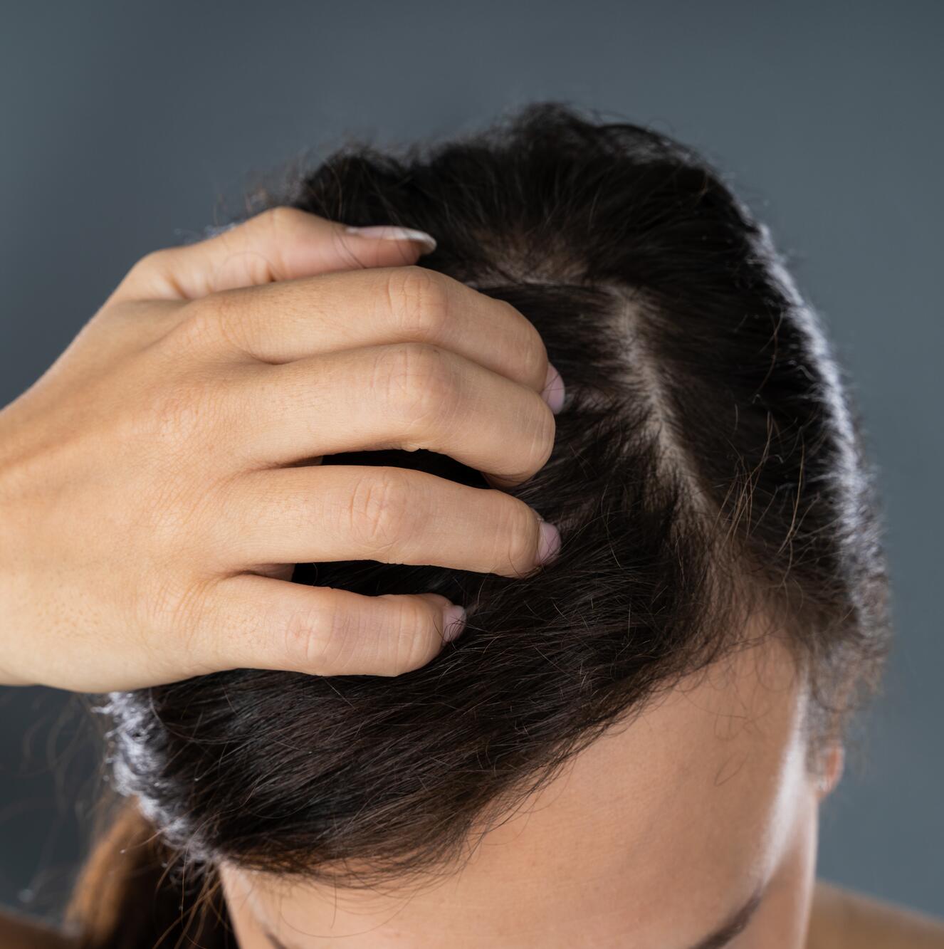 Calmar la dermatitis atópica en el cuero cabelludo