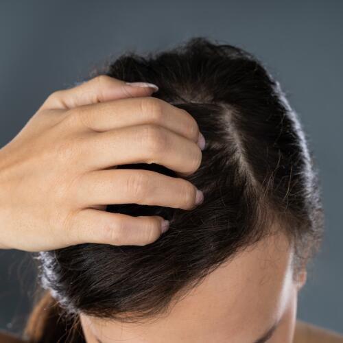 Linderung der Neurodermitis (atopischen Dermatitis) auf der Kopfhaut