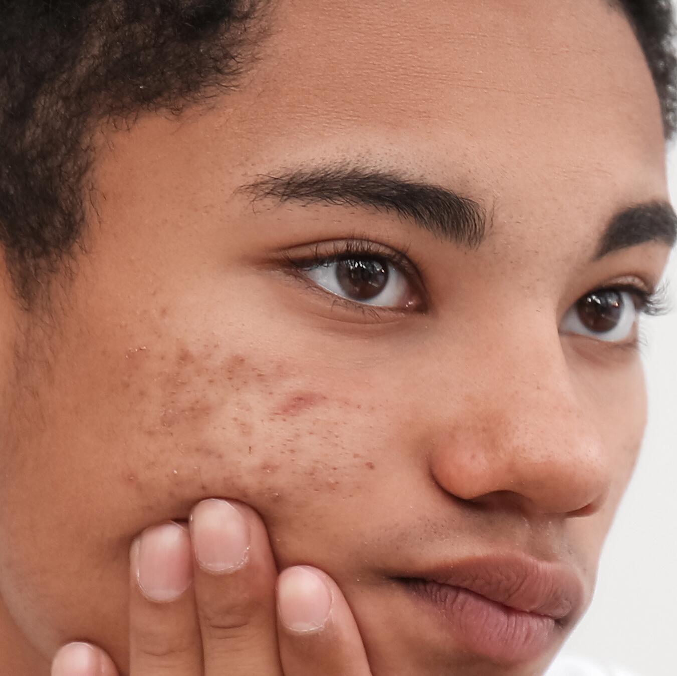 AD_ACNE-BOY_SQUARE_2021