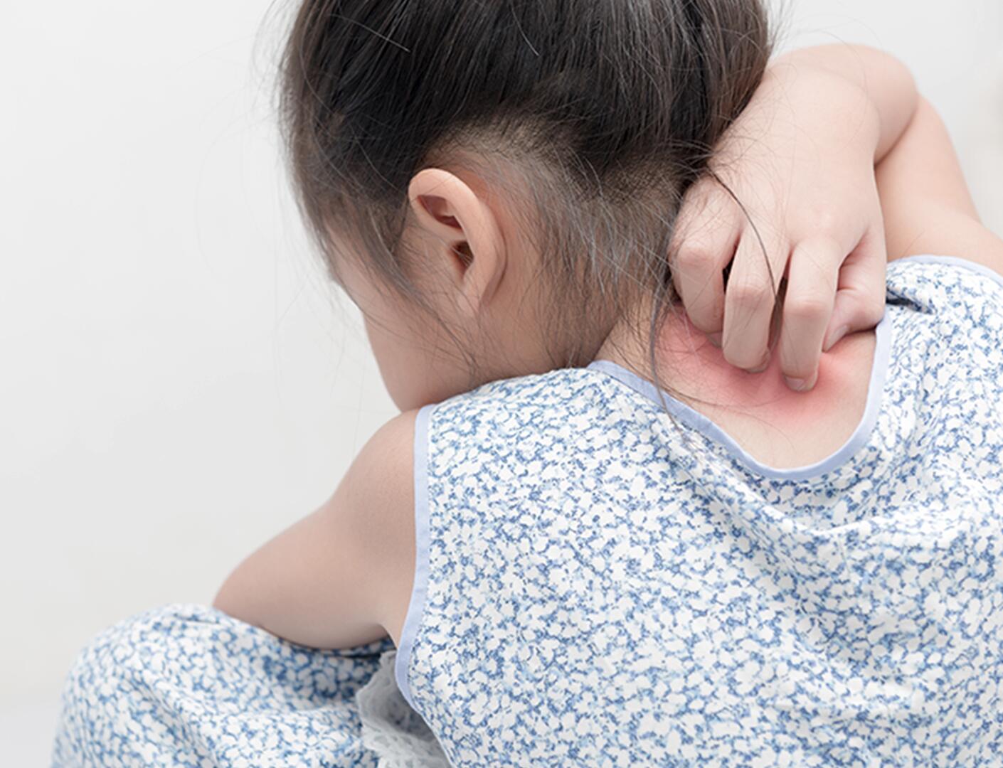 du_neurodermitis_silo_psoriasis_kinder_textmodul3_desktop_705x540