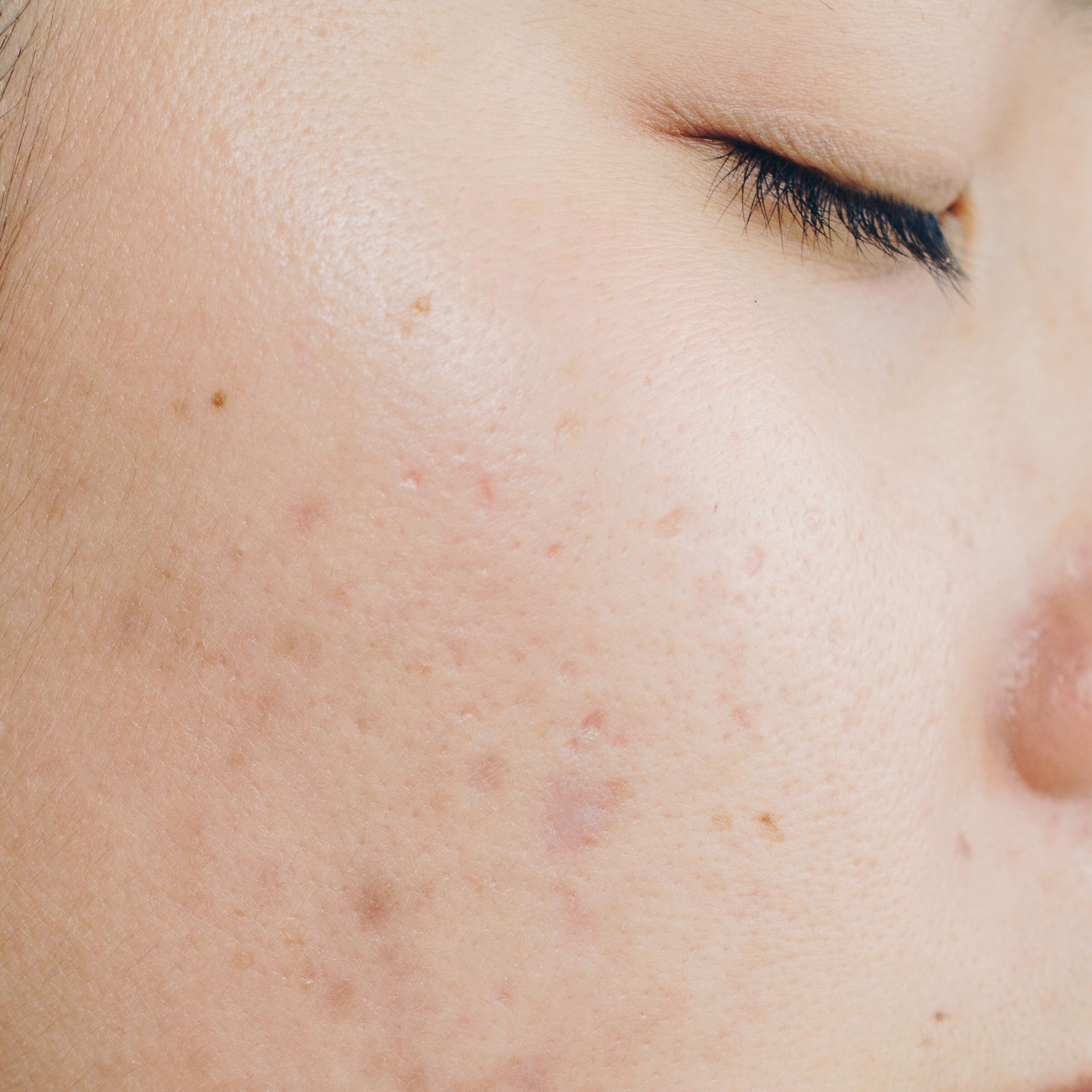 AD_ACNE_BROWN-SCAR_SQUARE