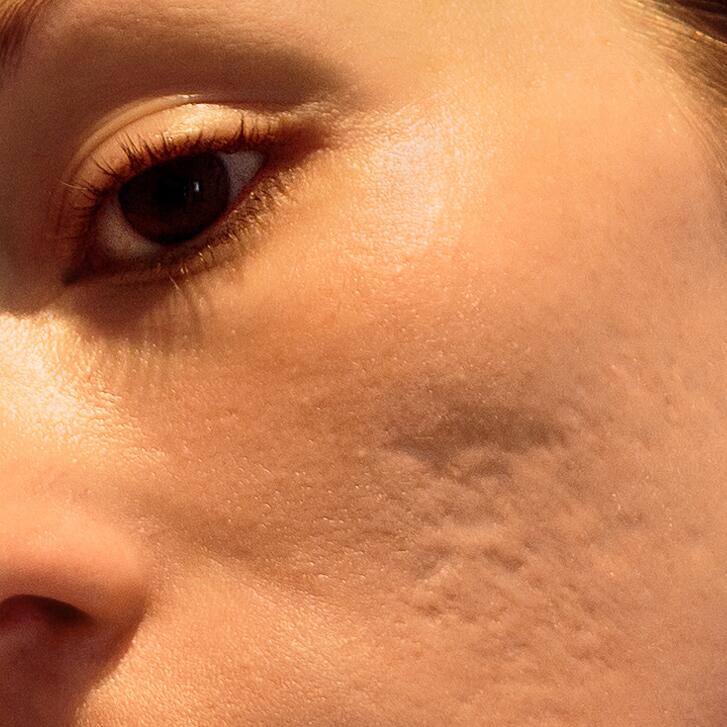 AD_ACNE-SCAR_SQUARE_2021
