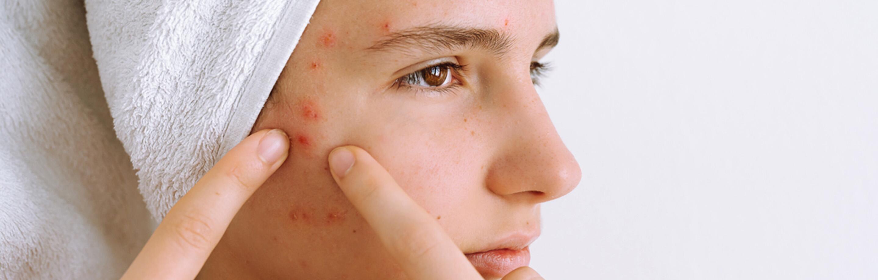 Acne conglobata Eau Thermale Avène