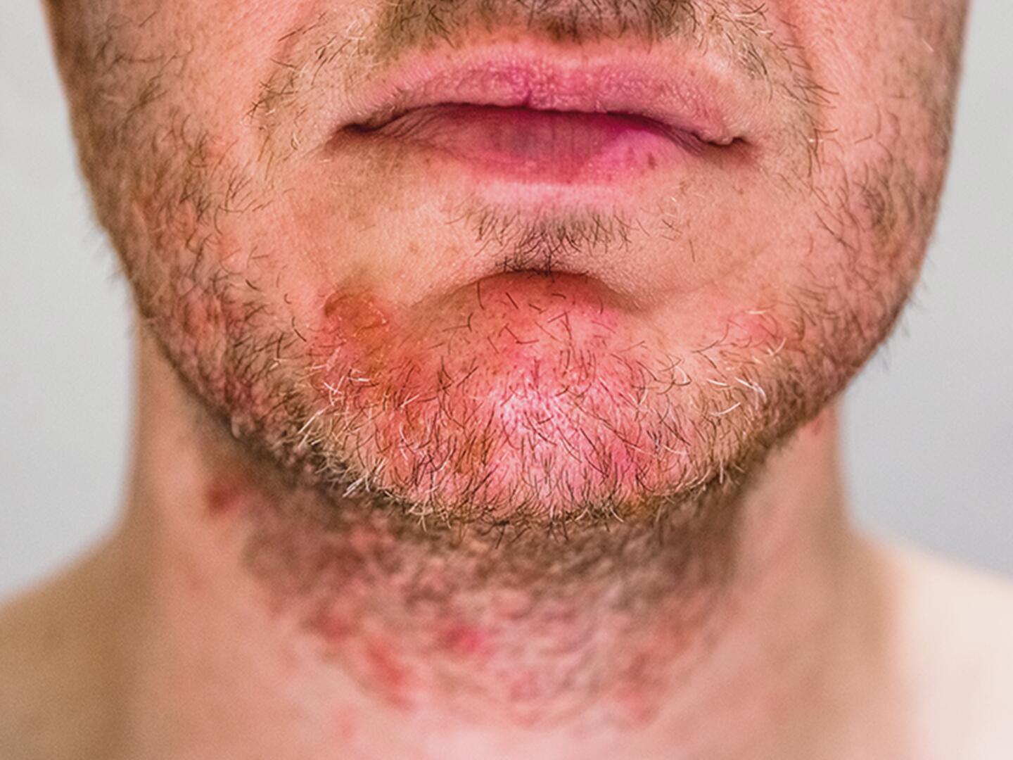 06_Seborrhoisches_Ekzem_DU_Seborrhoisches_Ekzem_textmodul2-png