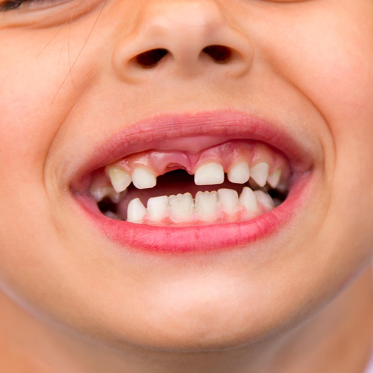 Diş kaybının öz güven üzerindeki sonuçları