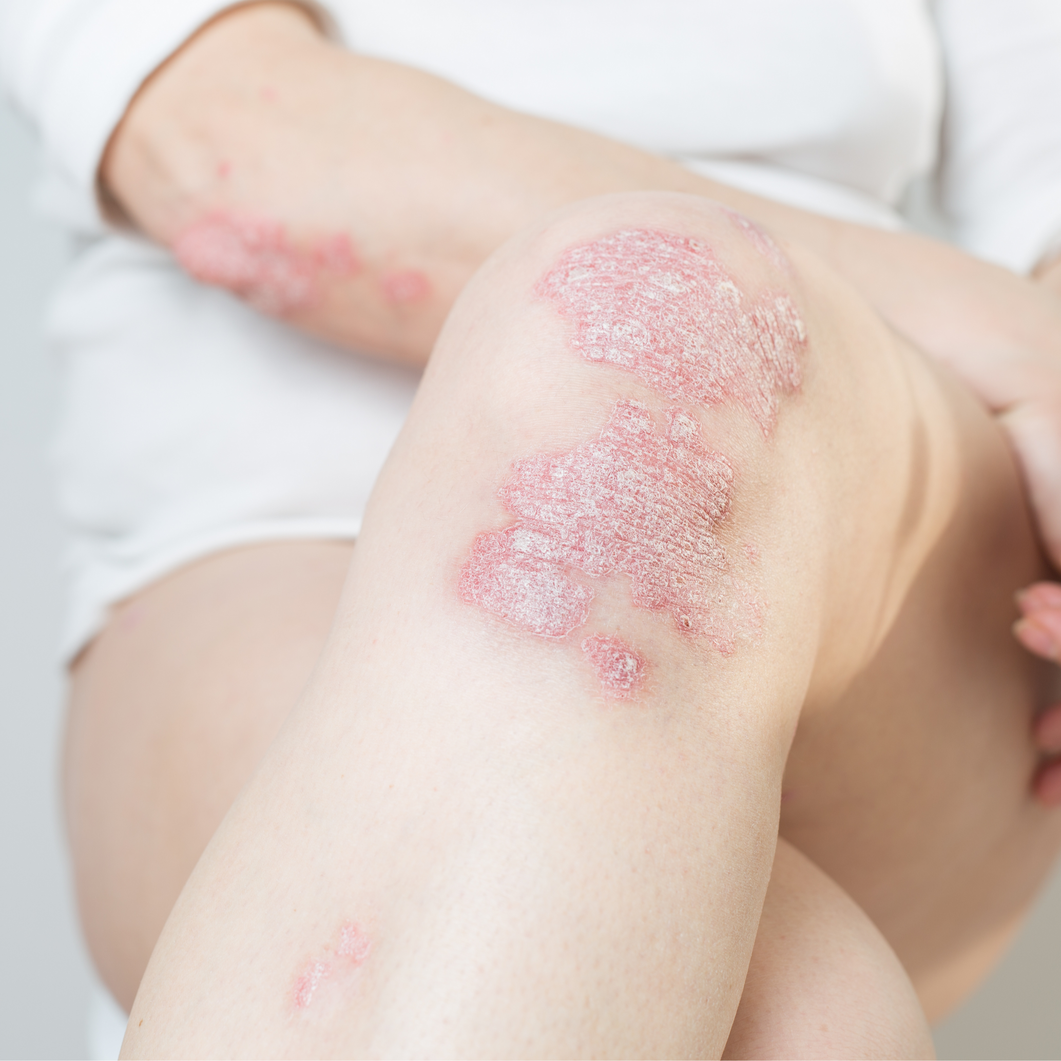 Peaux à tendance psoriasique