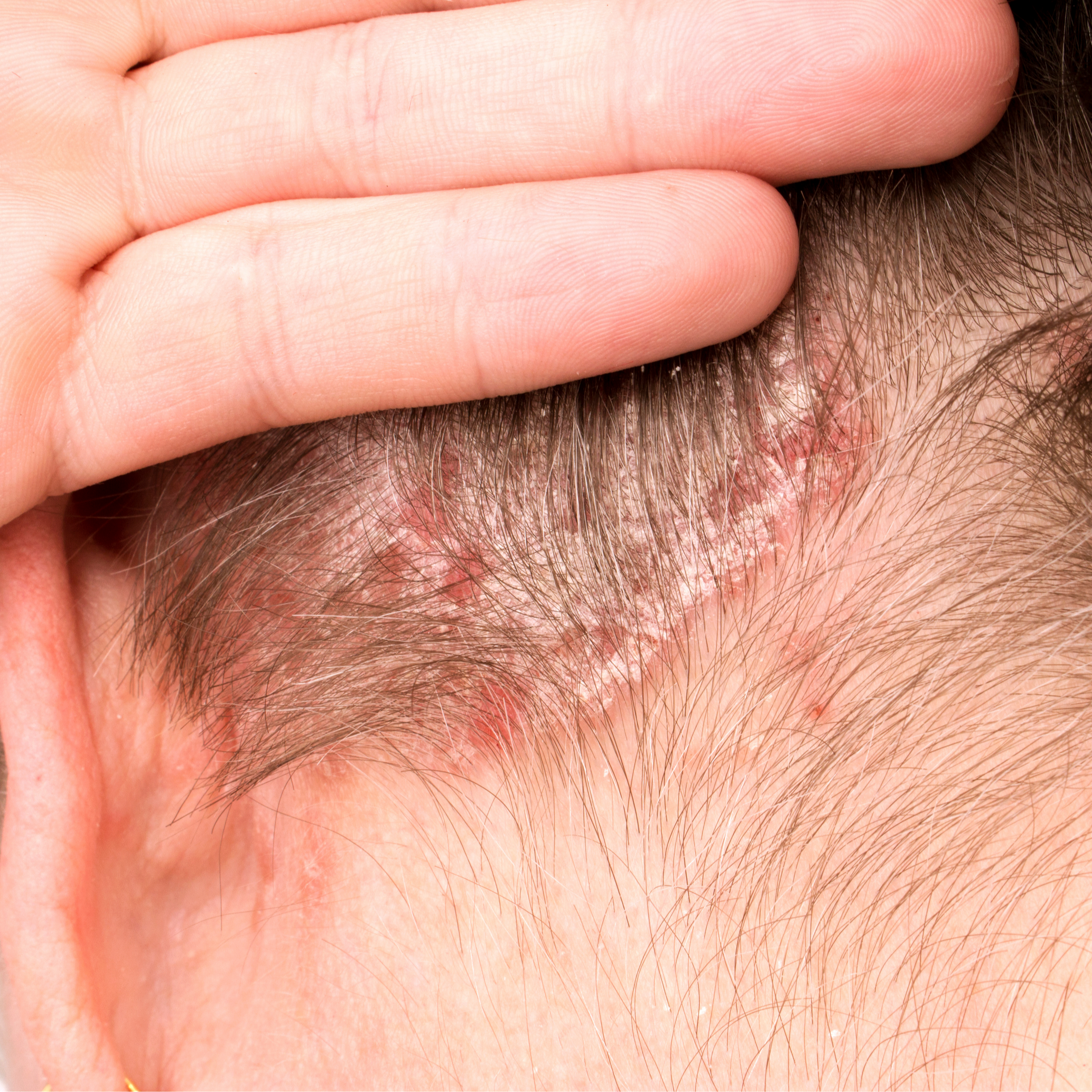 DU_KERTYOL-PSO_SILO_ITCHING_1x1