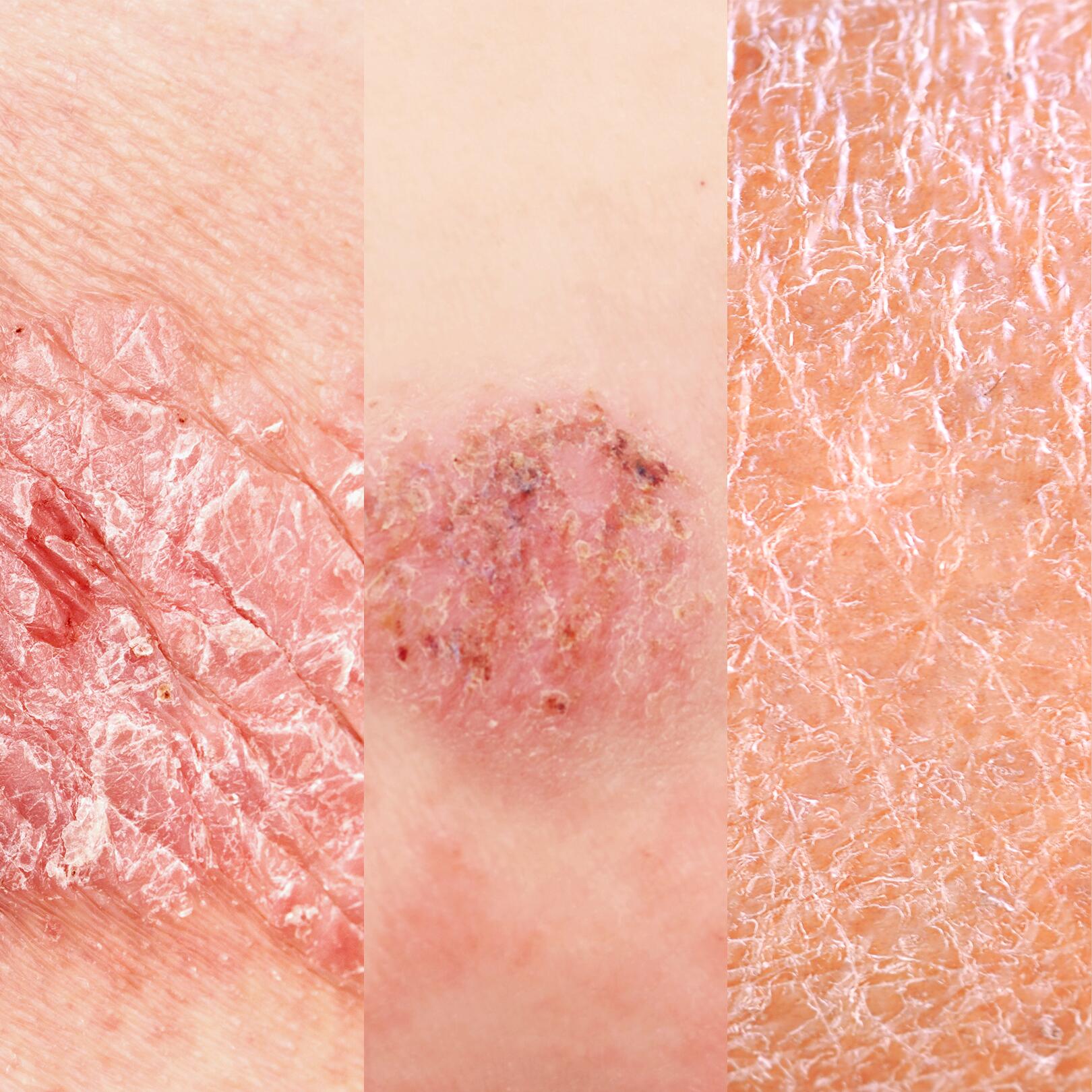 Le cause della pelle secca