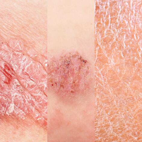Les causes d'une peau sèche