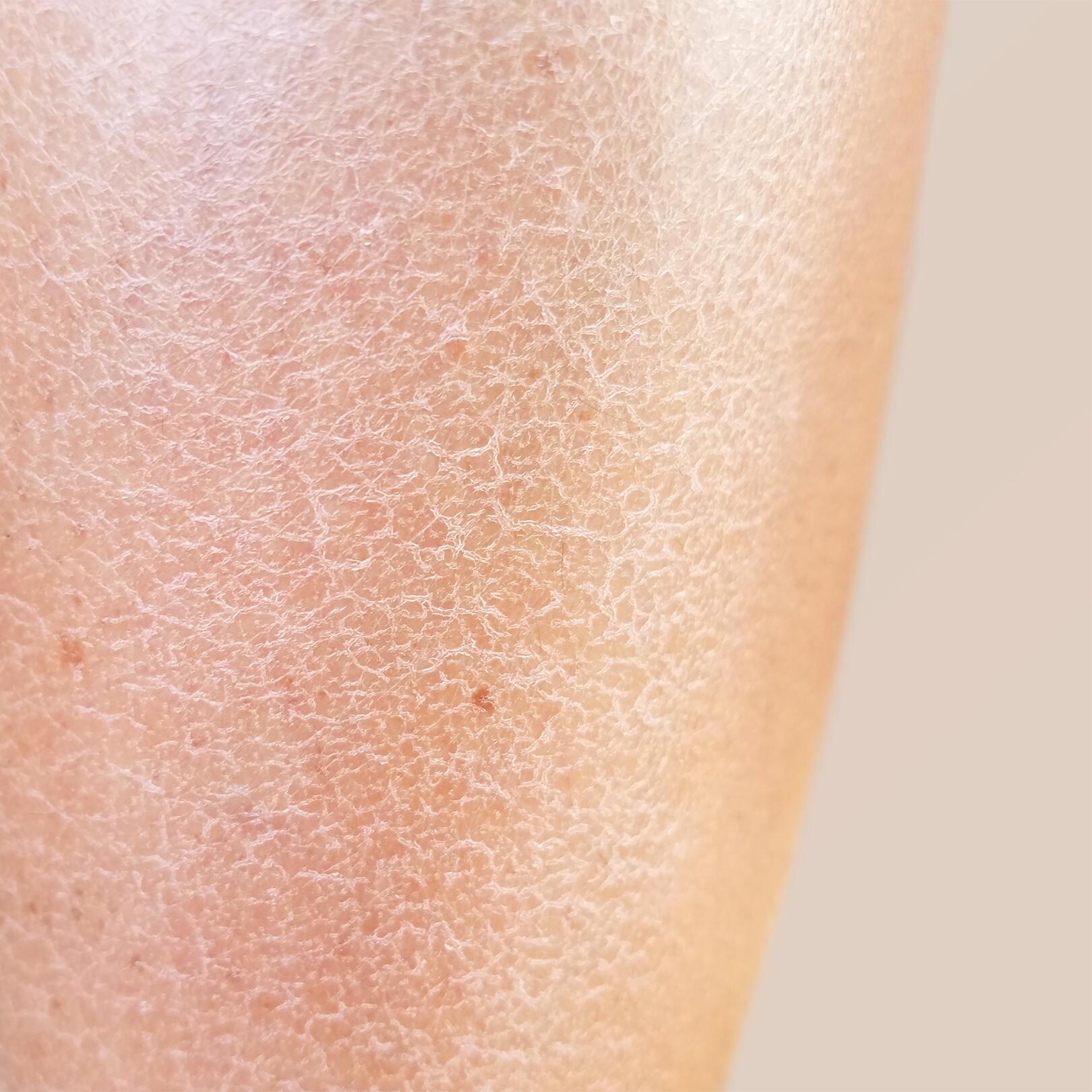Dry cracked legs outlet
