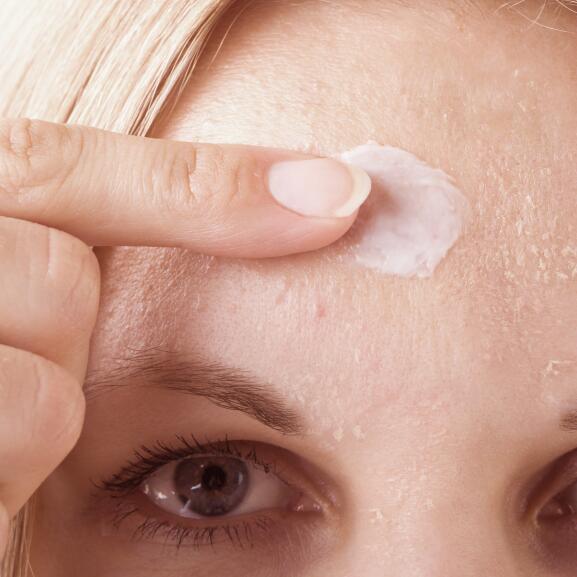 Schwere Akne und Isotretinoin: Passe deine Hautpflege an