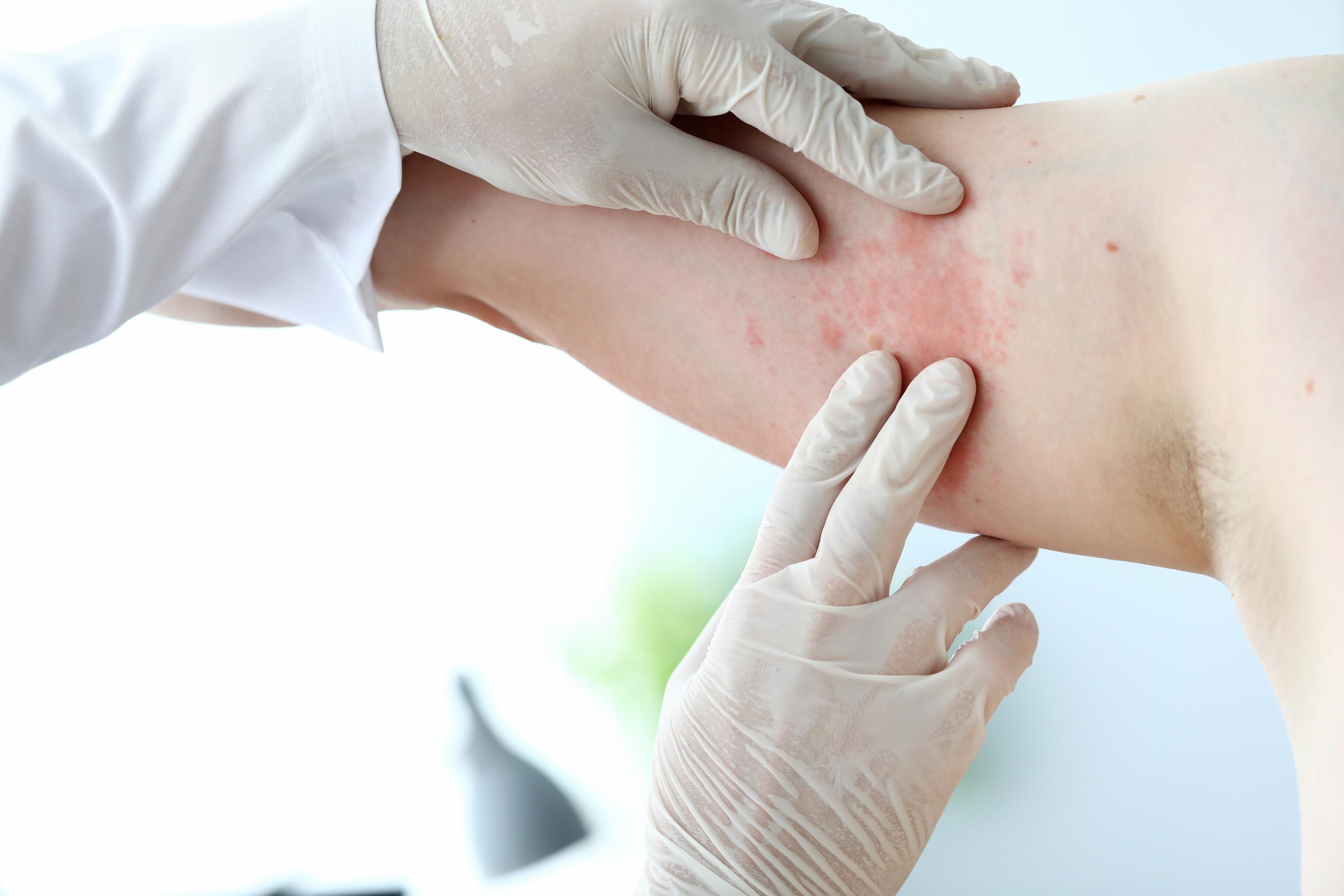 AD_website_eczema_contacts_2025