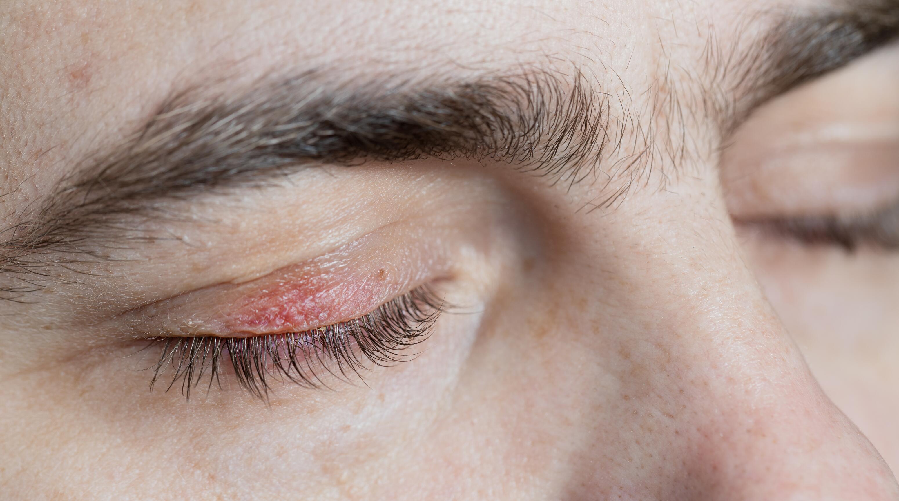 elfbar nachfüll pod läuft aus Nez sec et irrité : spray nasal lubrifiant, pommade pour les croutes main image 1