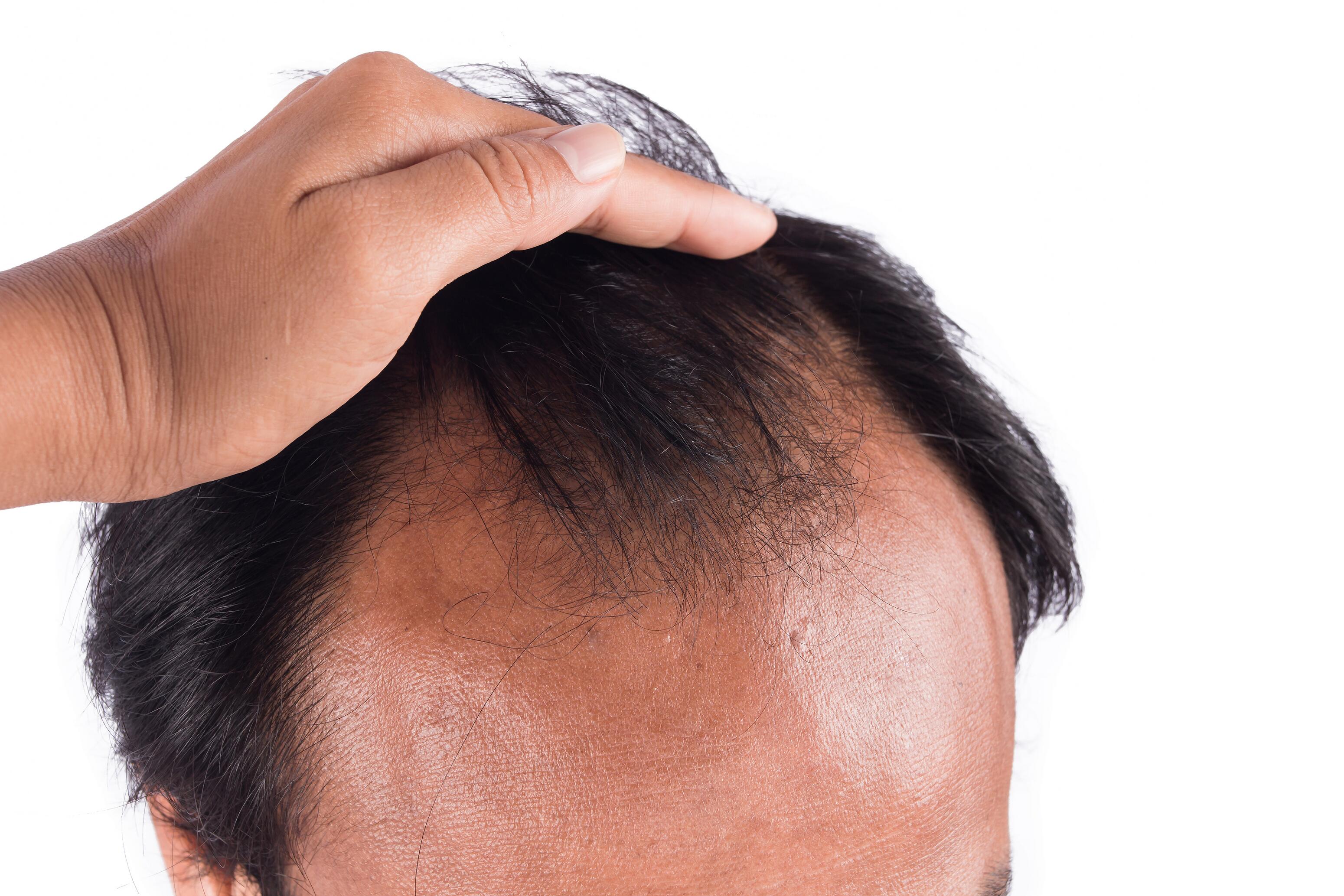 du_article_men-alopecia_header