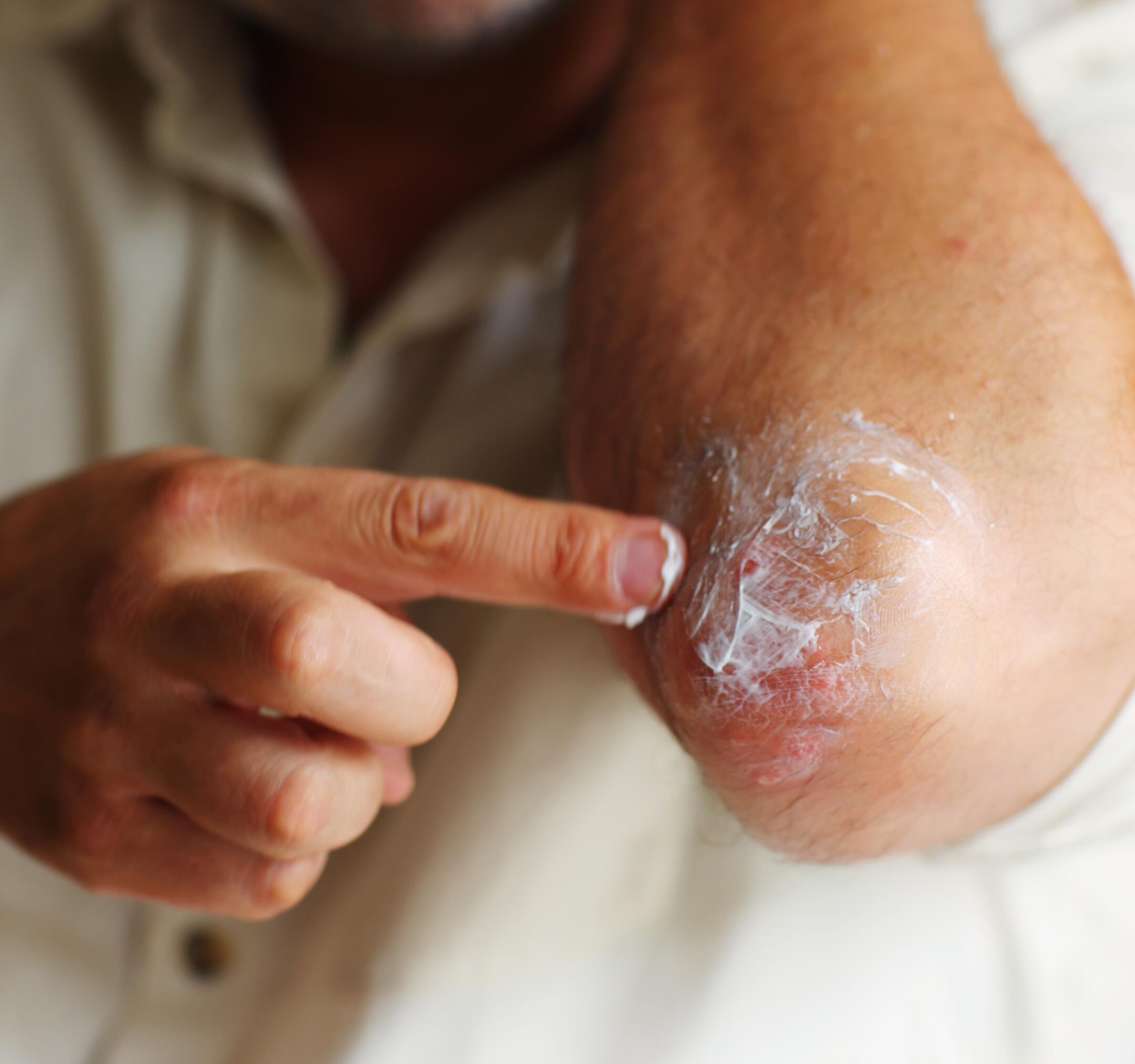 poussee-eczema-coude