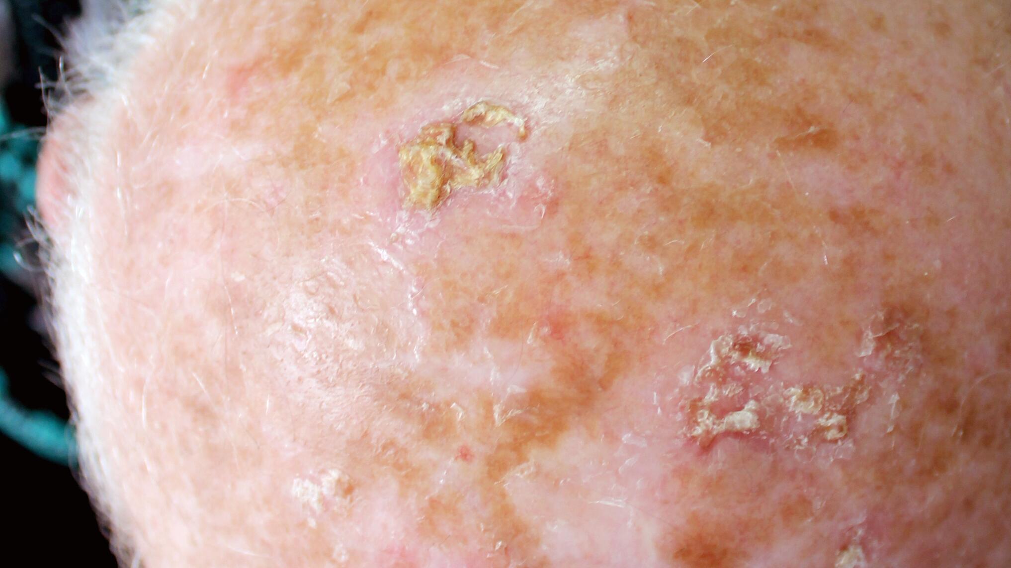 av_solaires_cancer_keratose-actinique_16x9