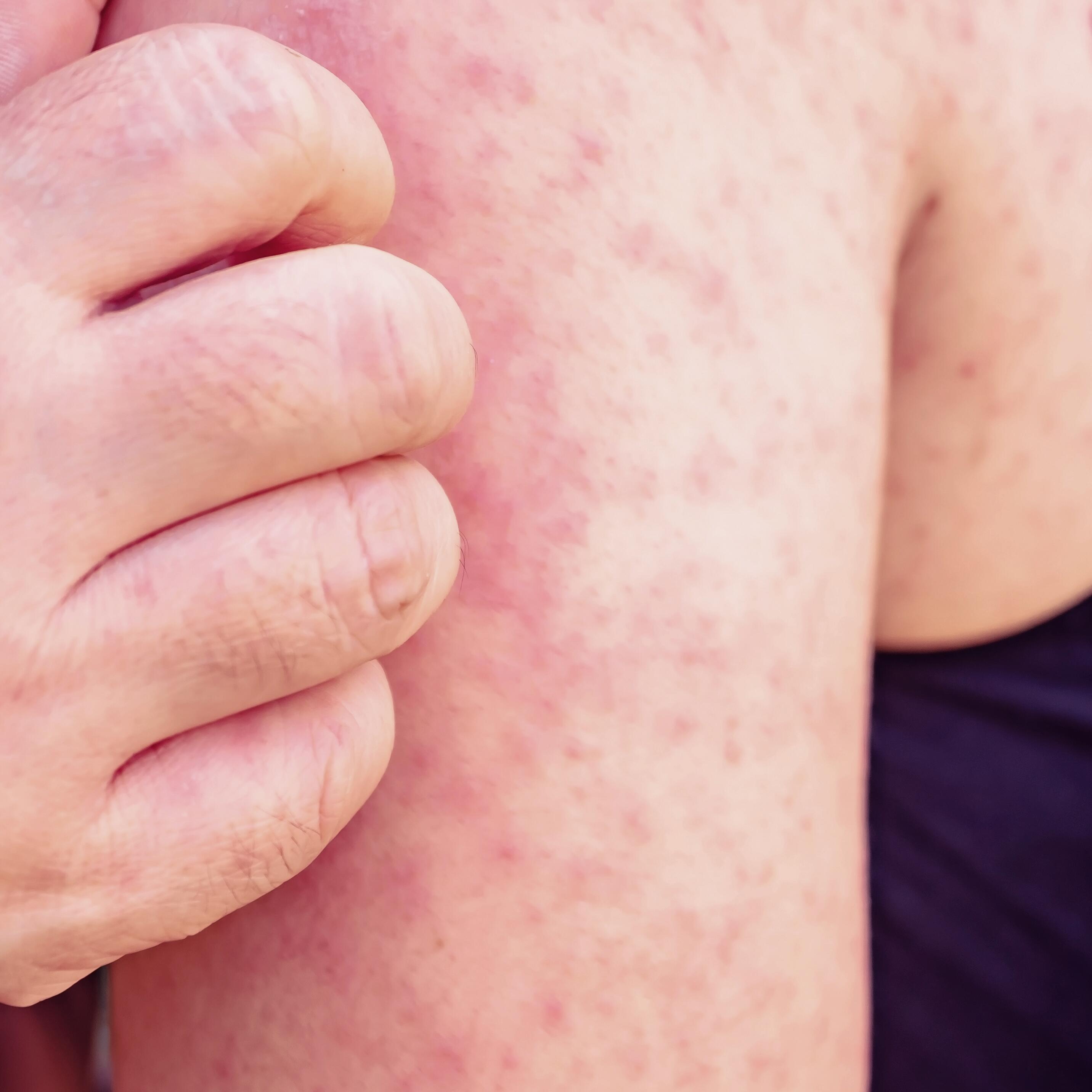 av_solaires_demangeaison_boutons_1x1