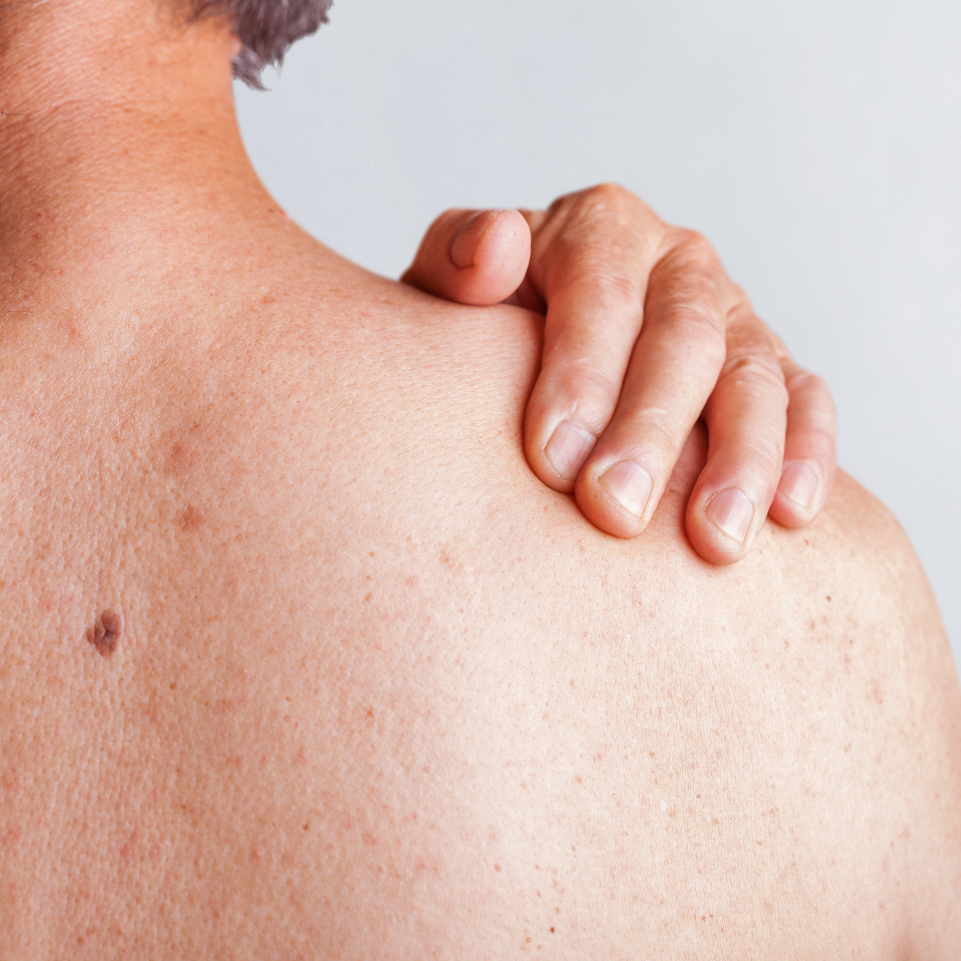 av_solaires_cancer-peau_homme_dos_1x1