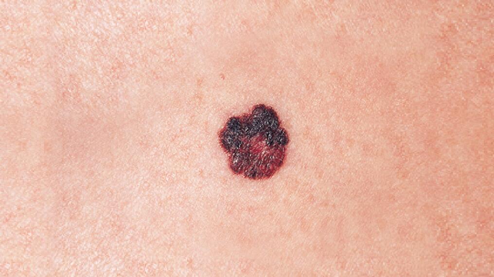 av_solaires_cancer-peau_melanome_16x9