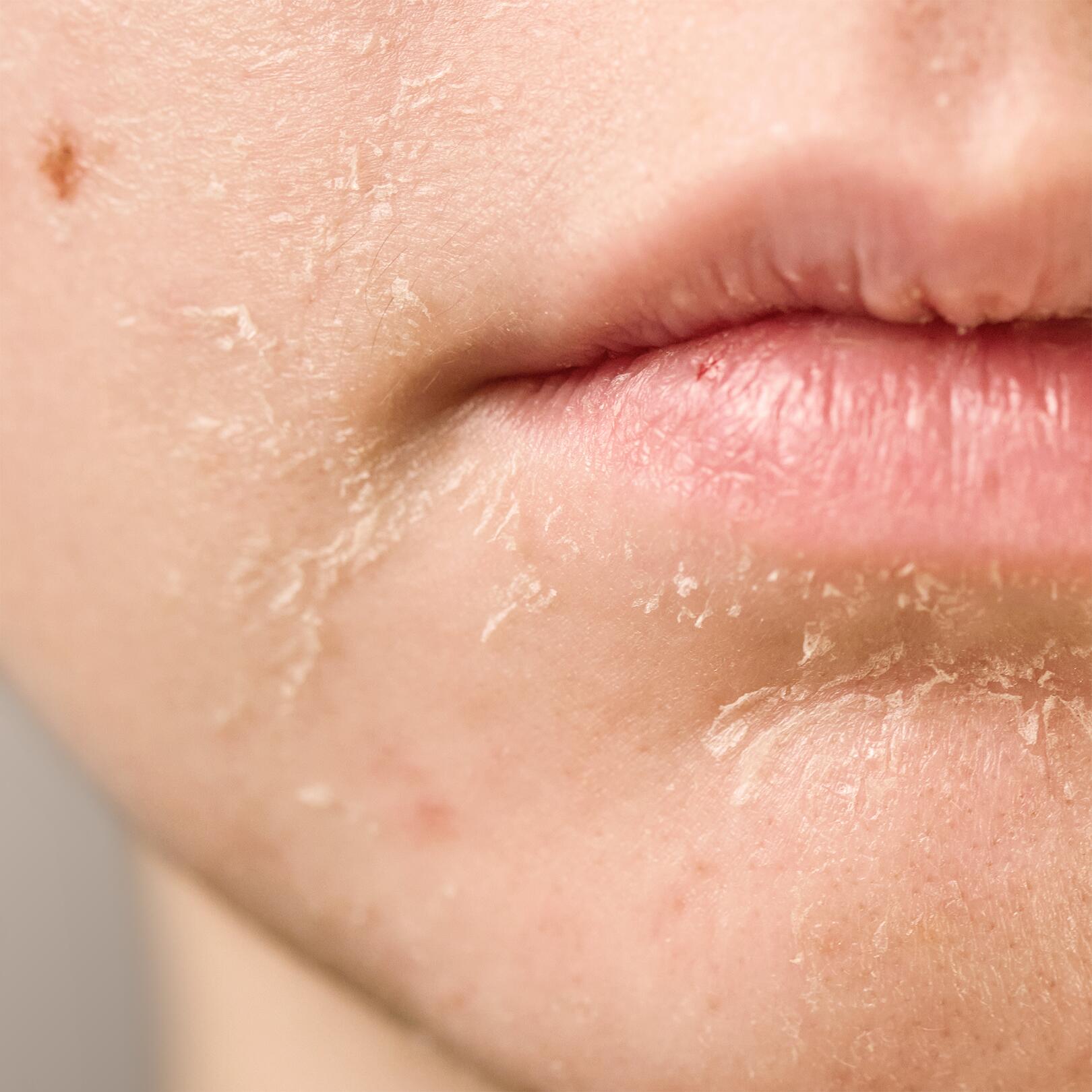 Sucha skóra: działanie uboczne niektórych leków