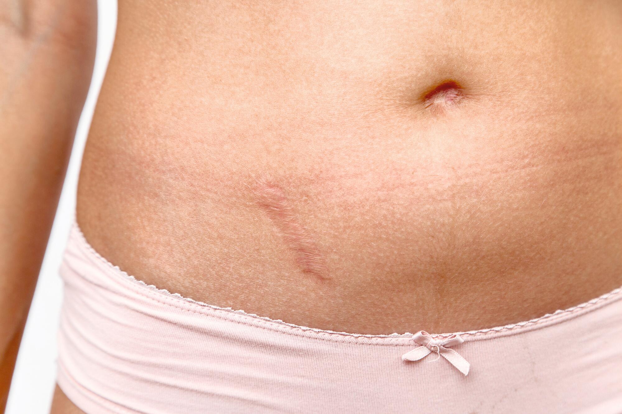 Nuestros consejos para cuidar la piel dañada