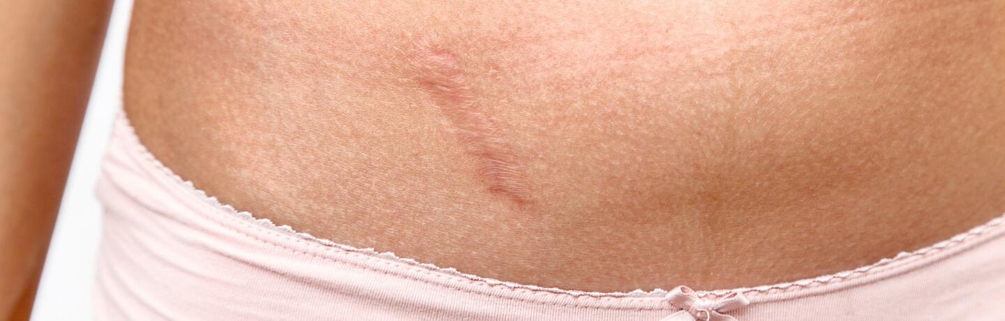 Eliminar cicatrices (estrías, cesáreas, etc.) | A-DERMA