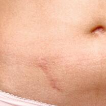 AD_SCARS_STOMACH-BELLY-WOMAN_LARGE_2021