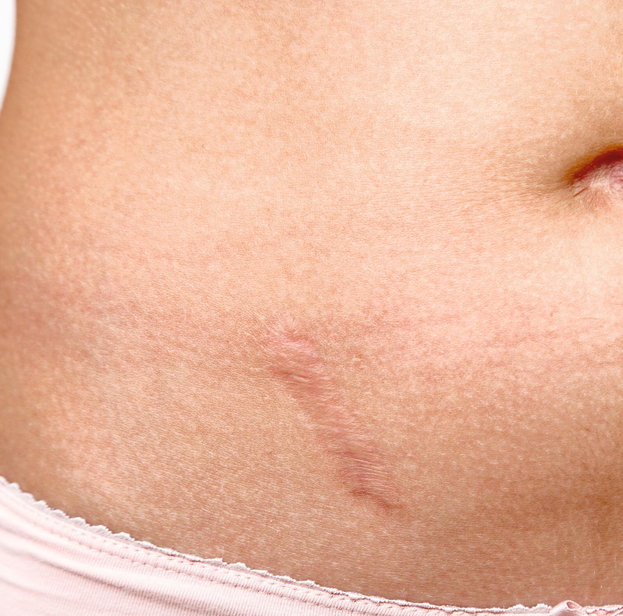 AD_SCARS_STOMACH-BELLY-WOMAN_SQUARE_2021