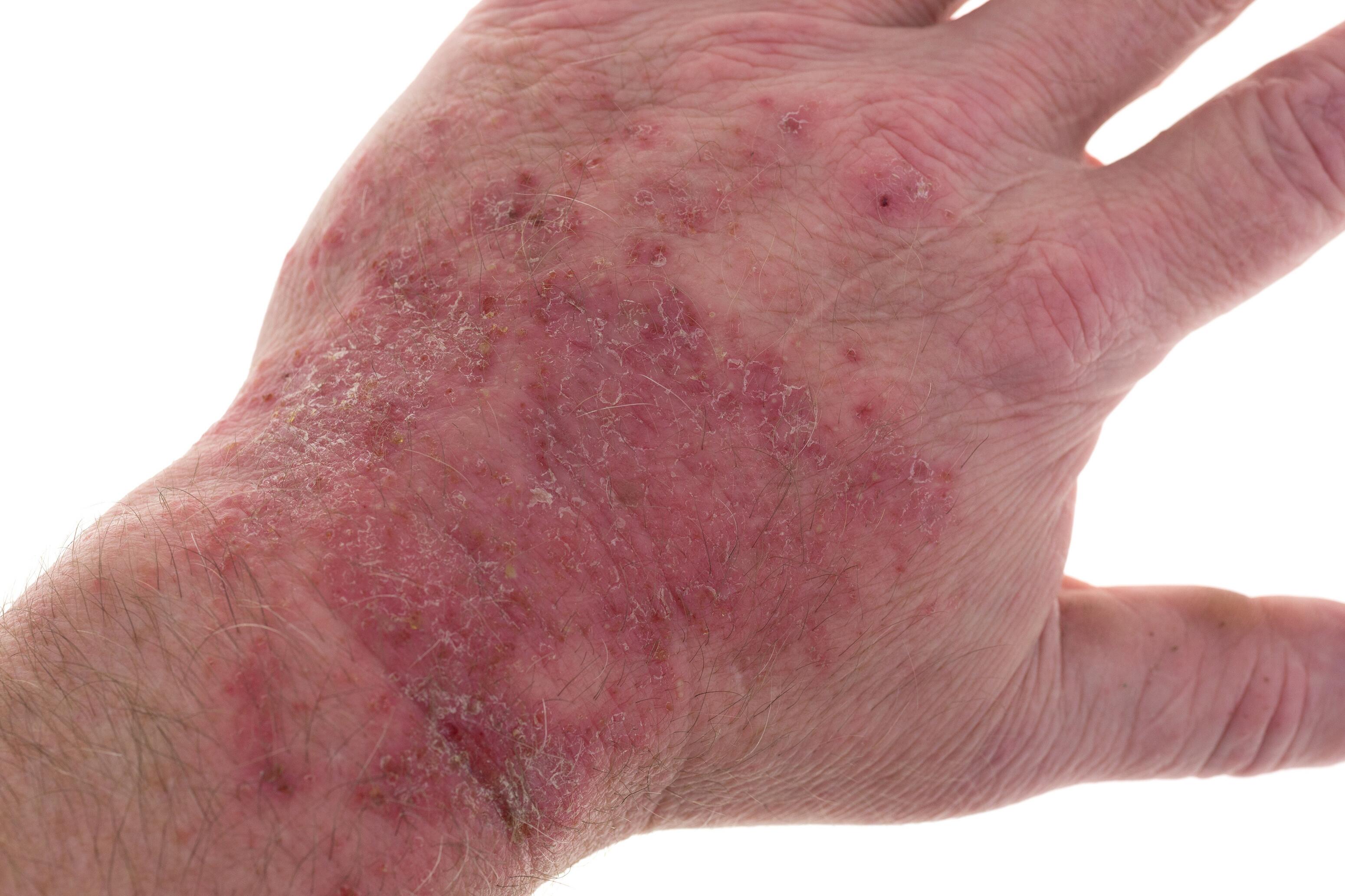 What is eczema?