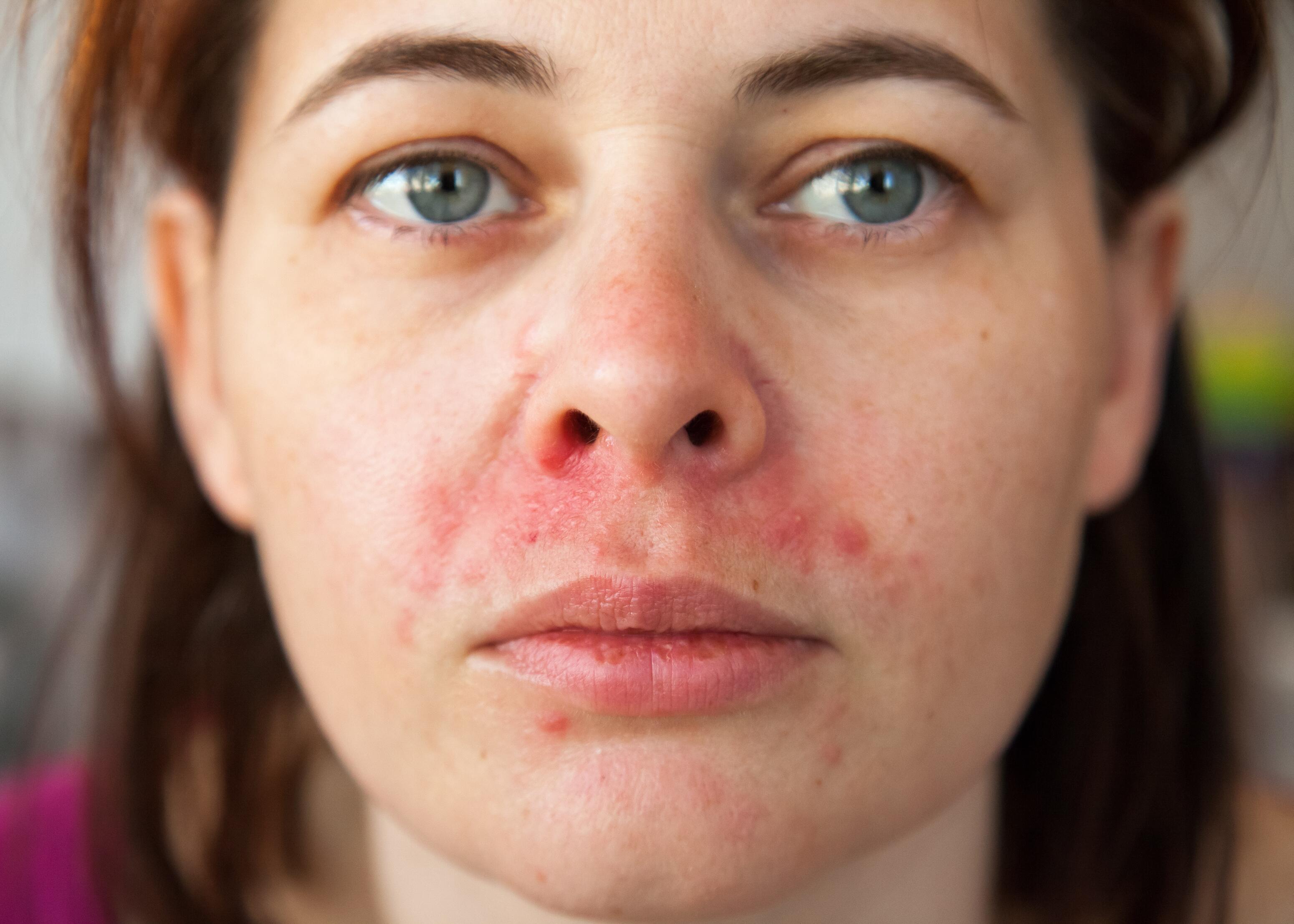 eczema-cara-mujer