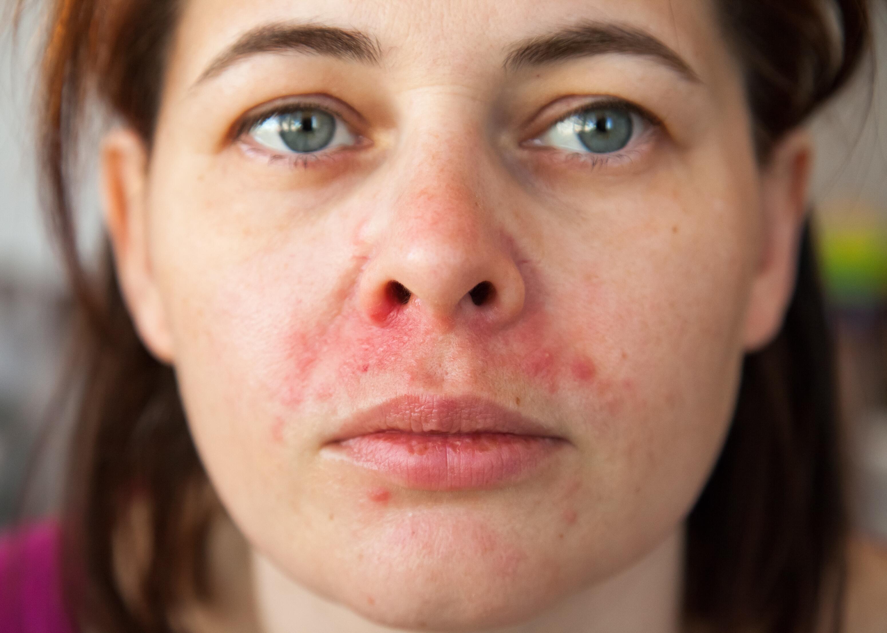 Femme avec de l’eczéma sur le visage