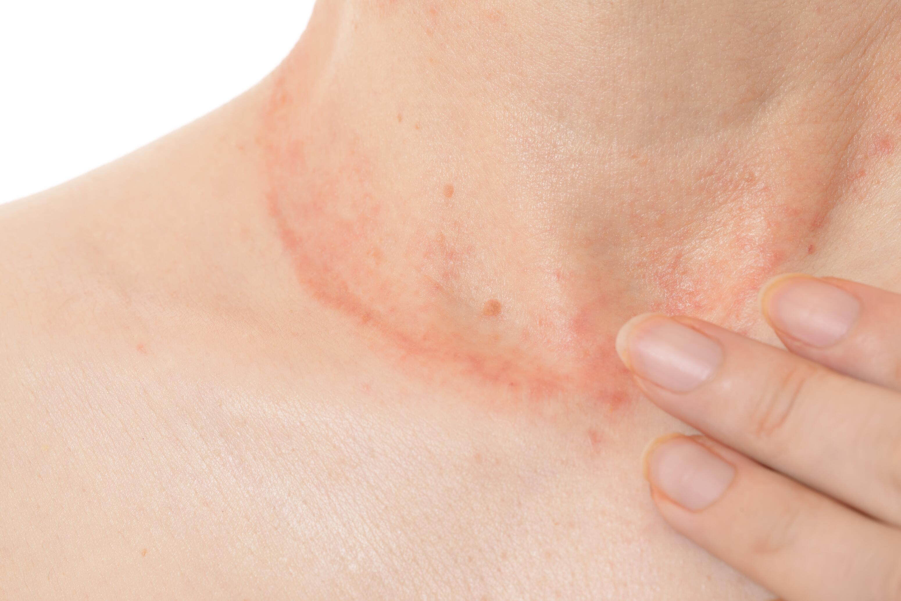 Woman with contact eczema around the neck due to allergy