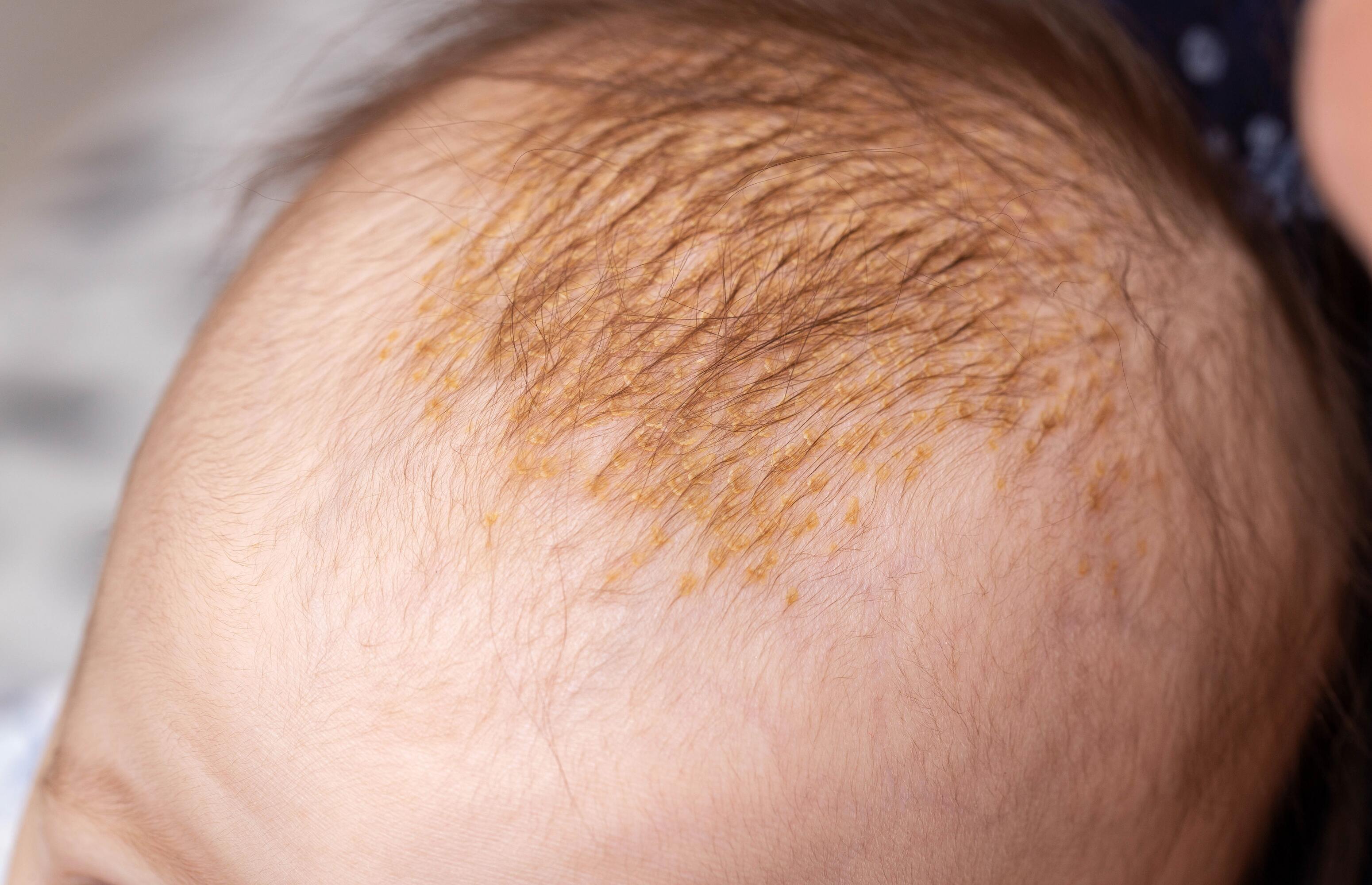Scalp of a baby with seborrheic dermatitis