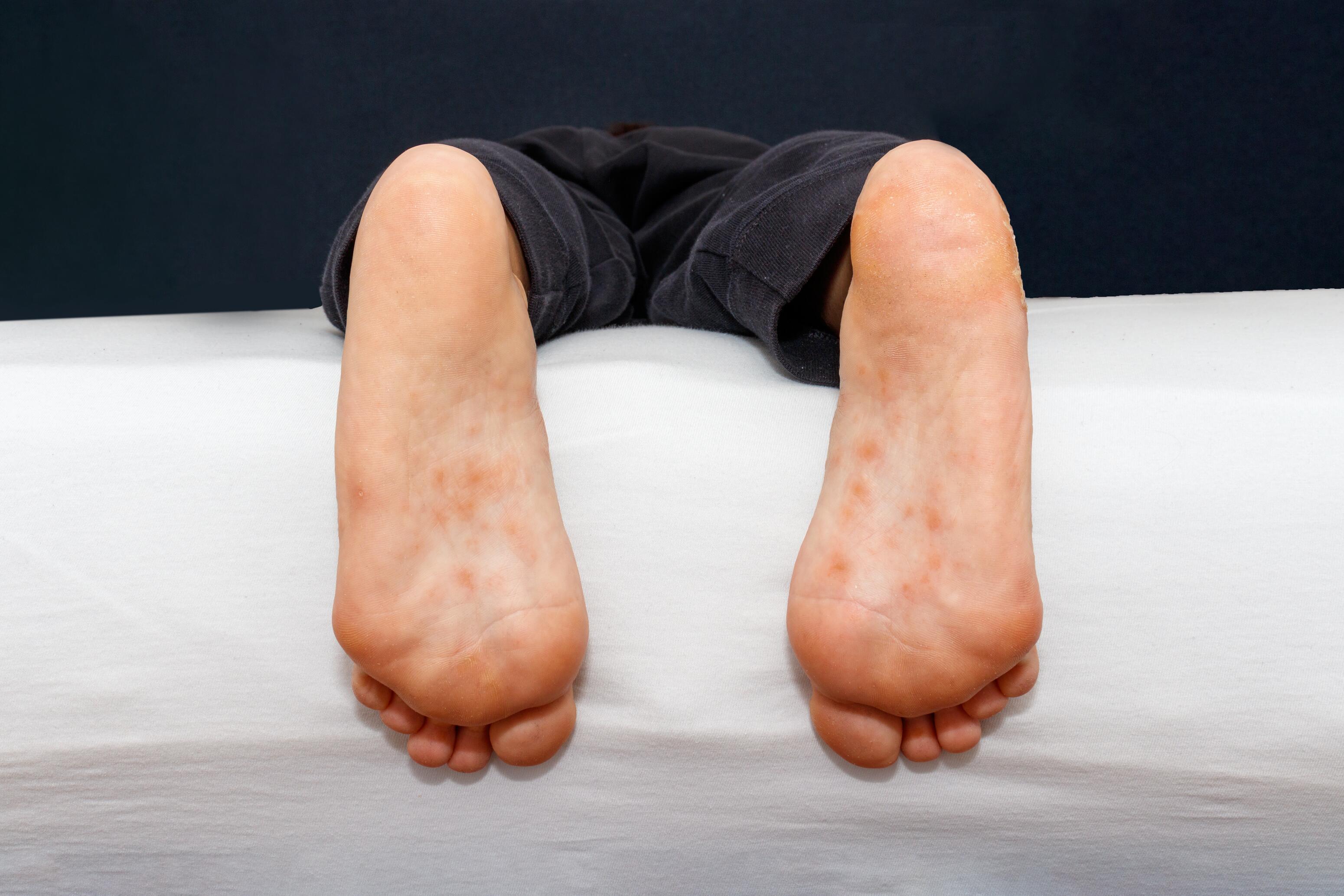 Dyshidrosis of the feet