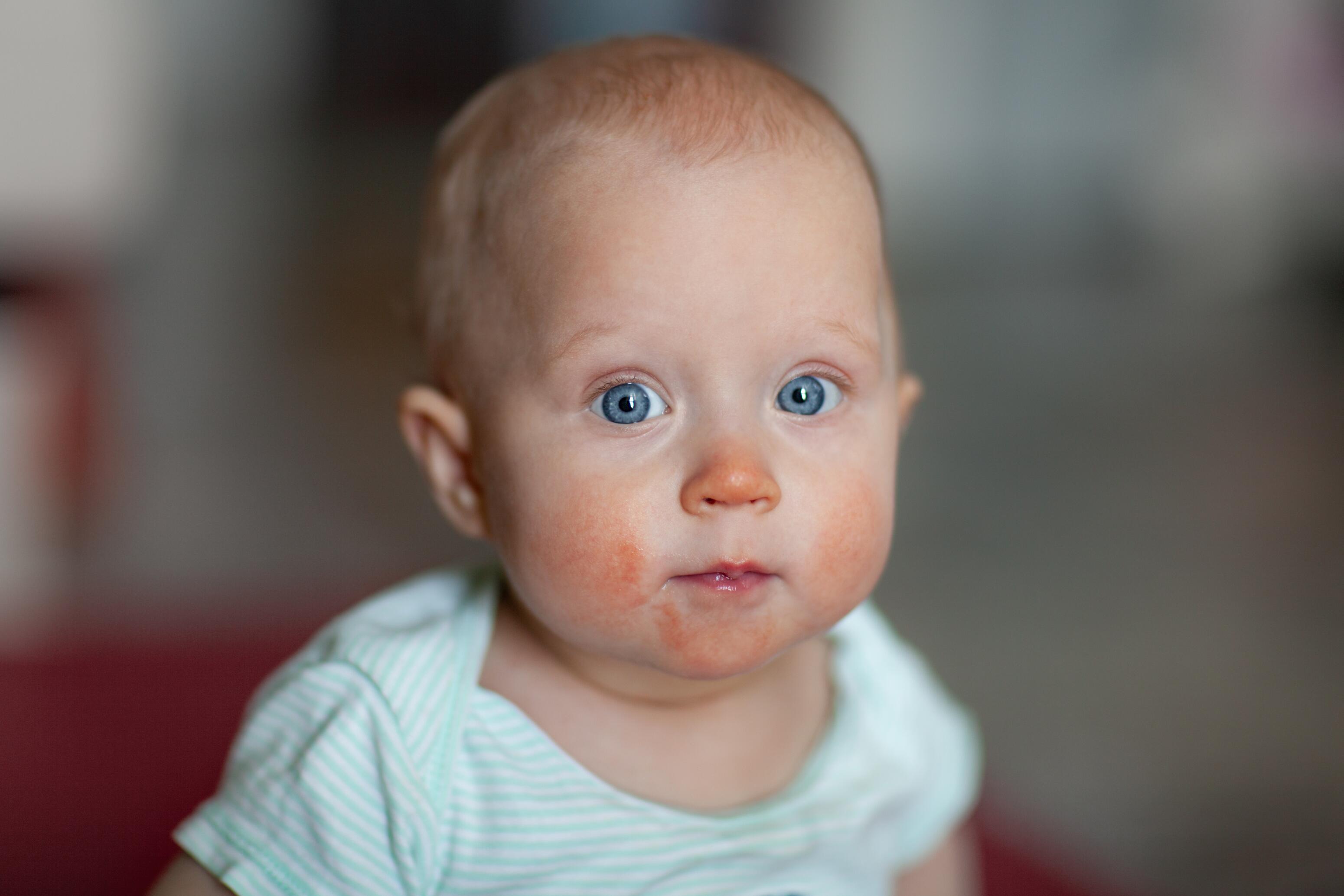 Bébé avec de la dermatite atopique sur le visage