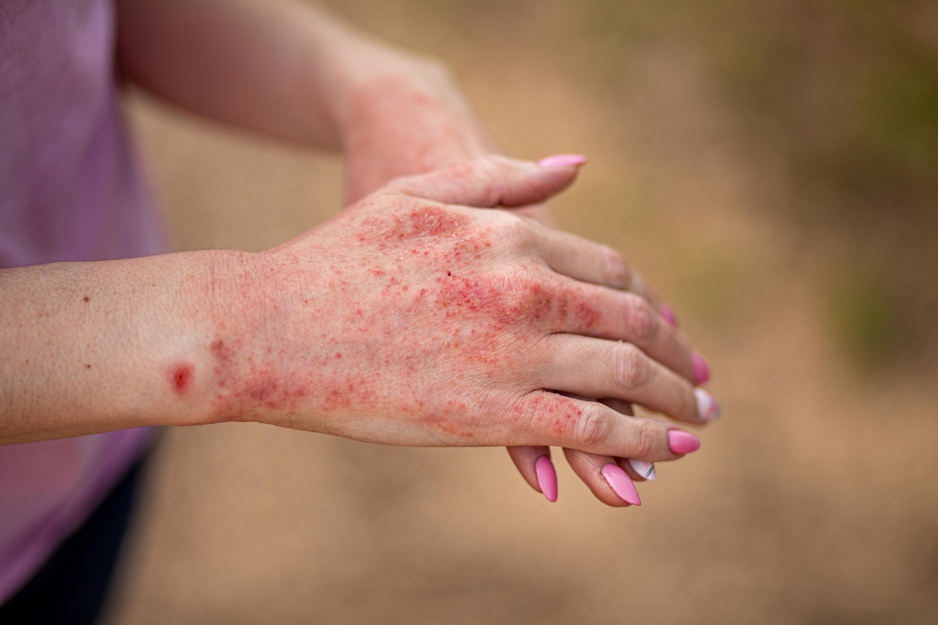 Woman with atopic eczema on her hands