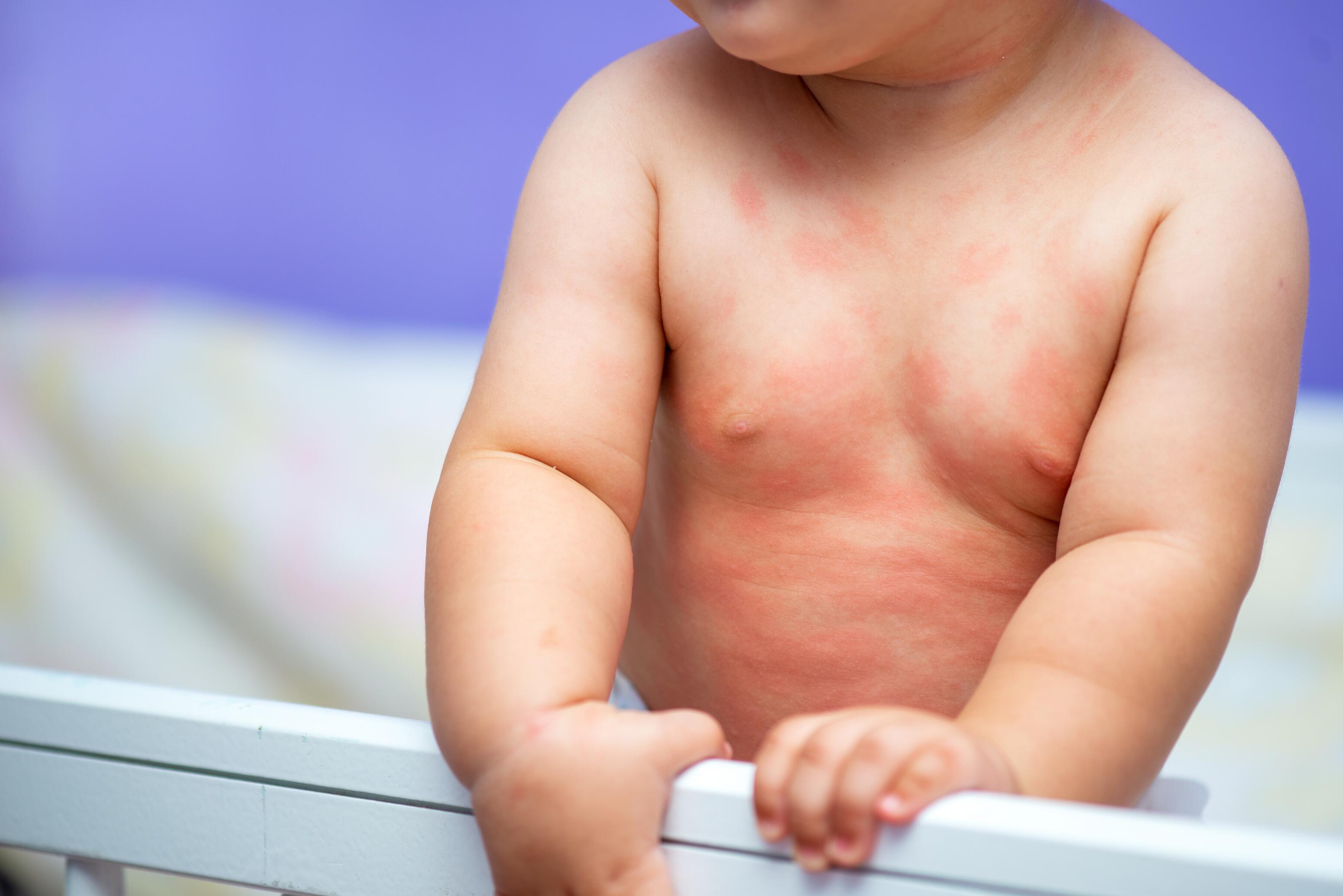 Tratamiento del eczema en los bebés