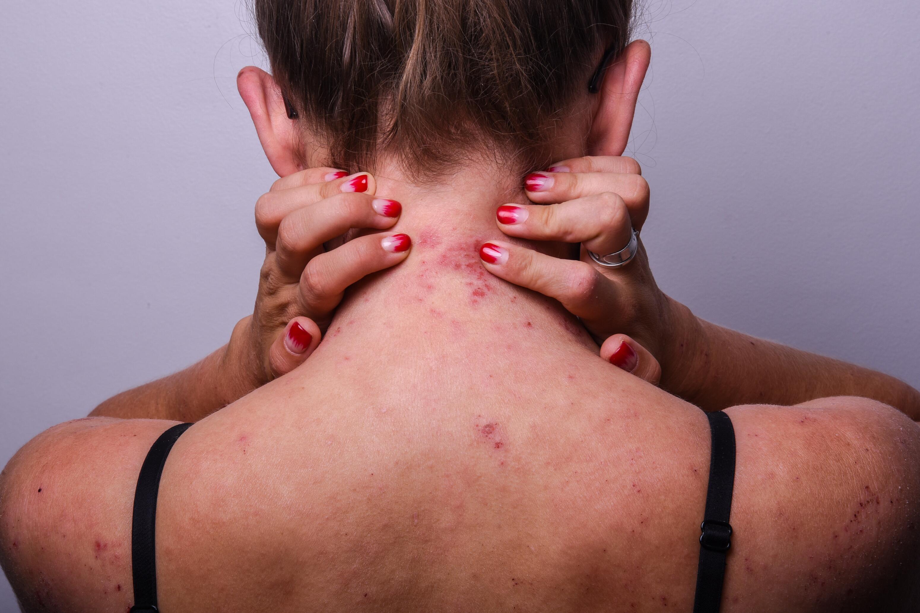 Woman with atopic eczema on the nape of the neck and back