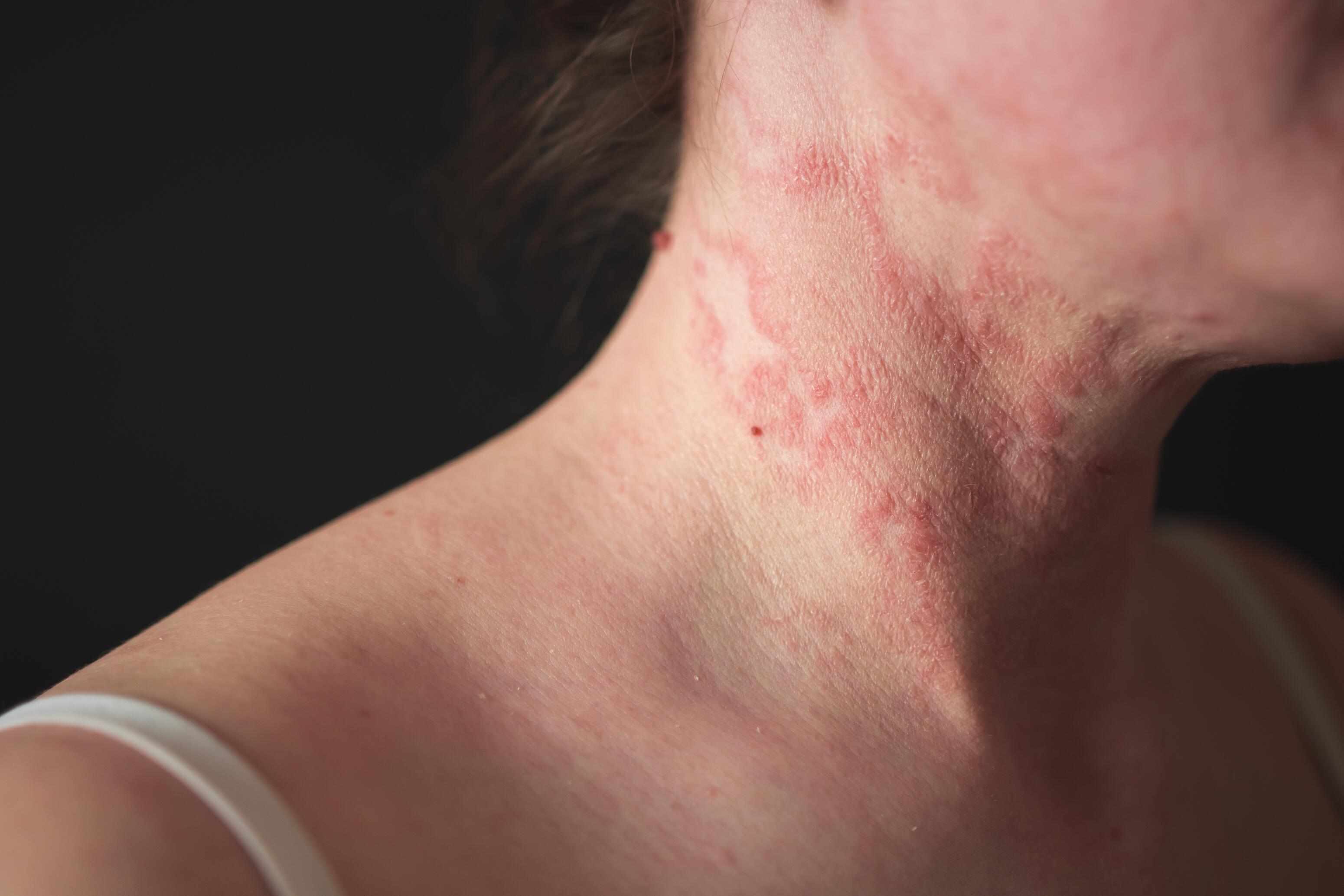 Neck of a woman with a flare-up of eczema patches