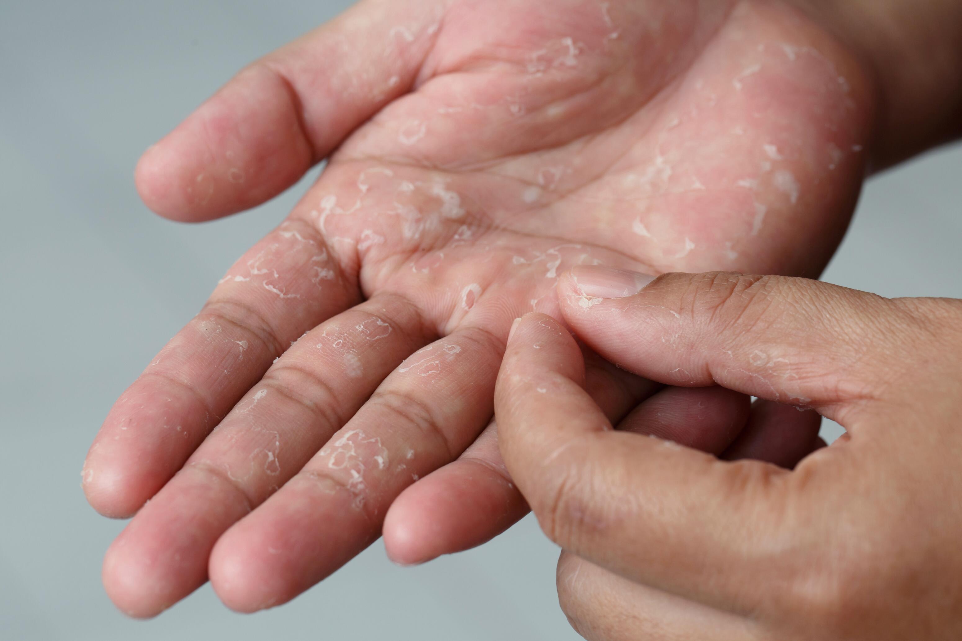 Otros tipos de eczema