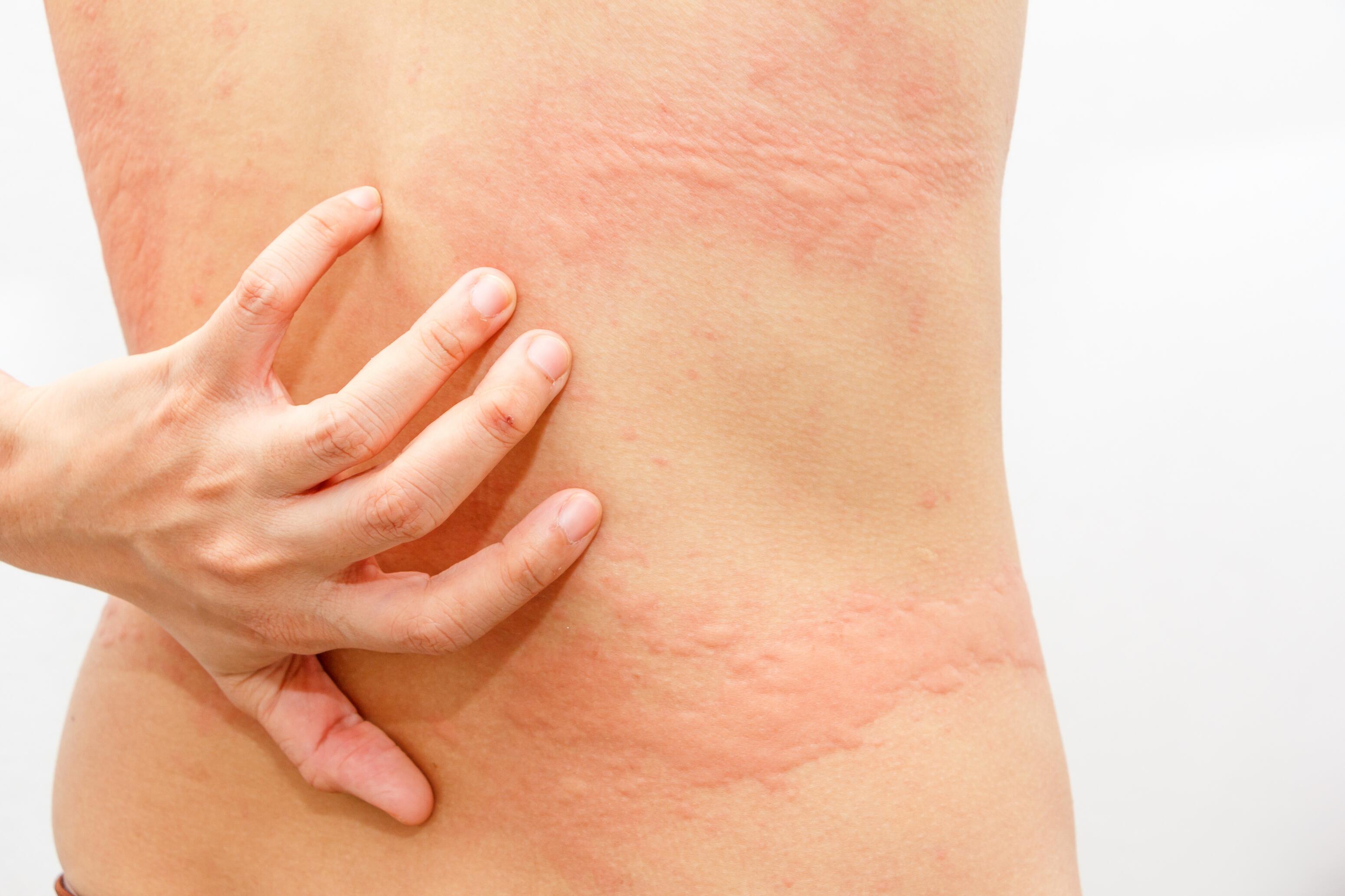 Woman scratching her back because of itching caused by hives