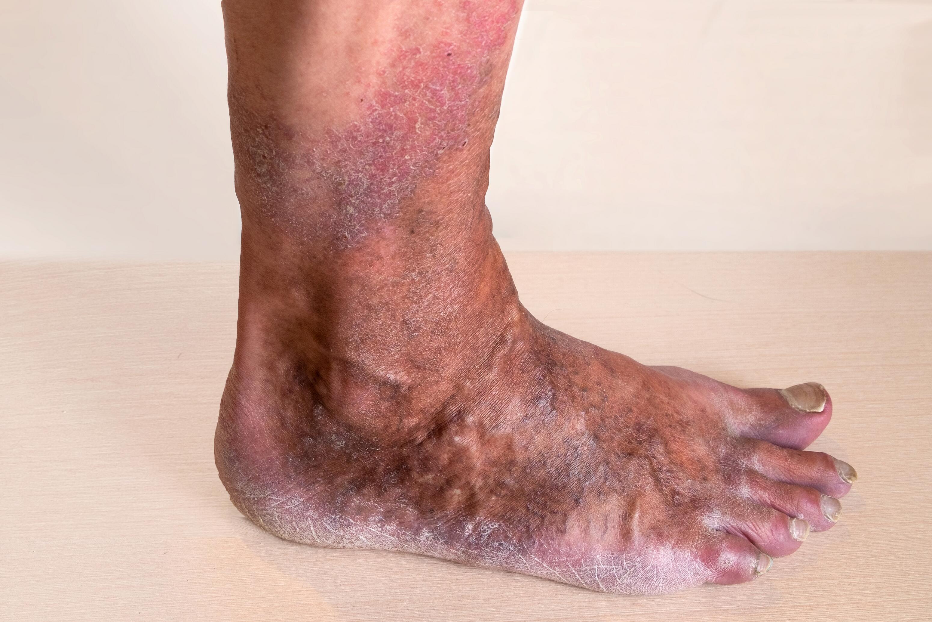 Ankle with varicose eczema