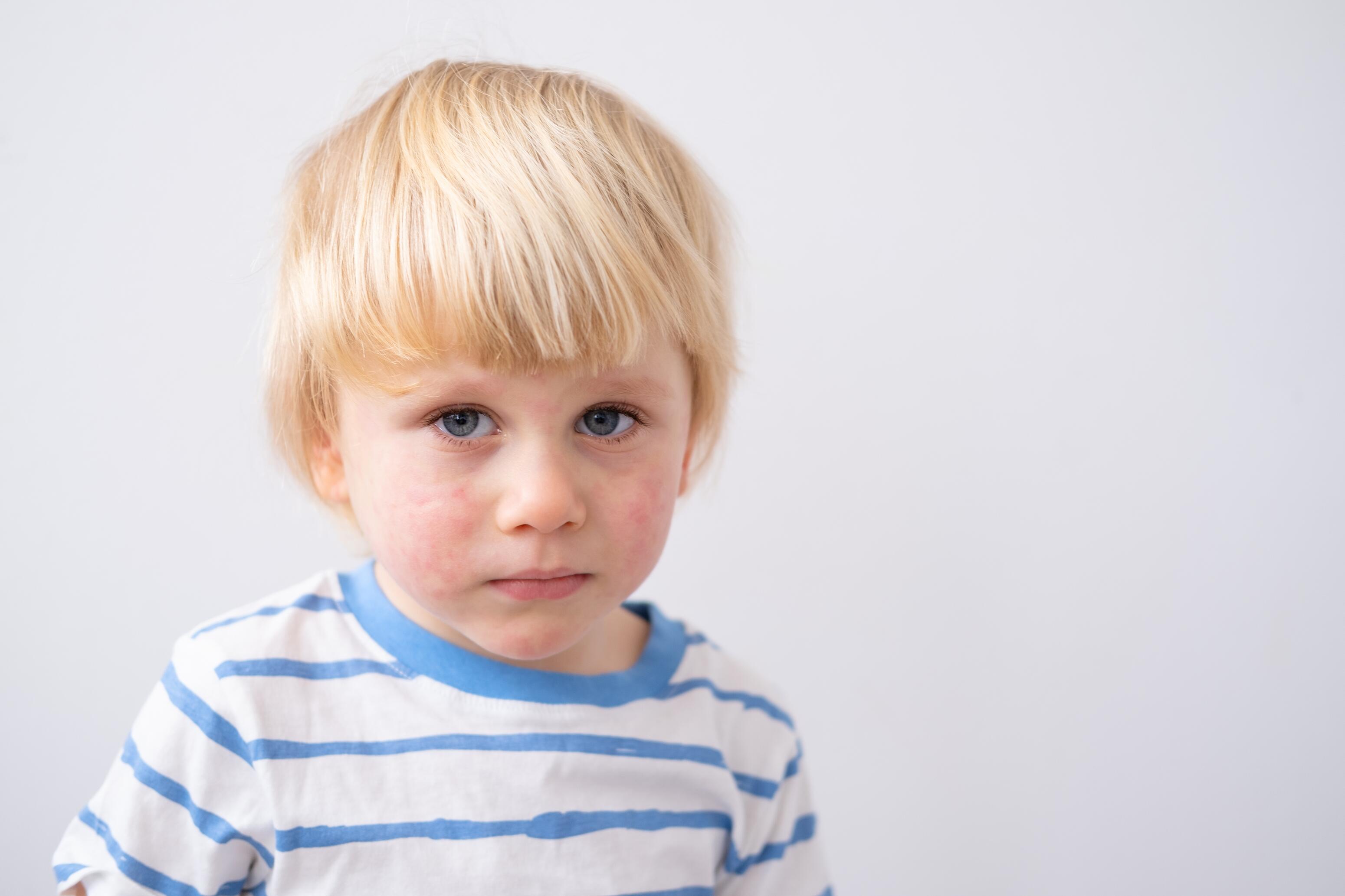 eczema-face-emollient-dexeryl